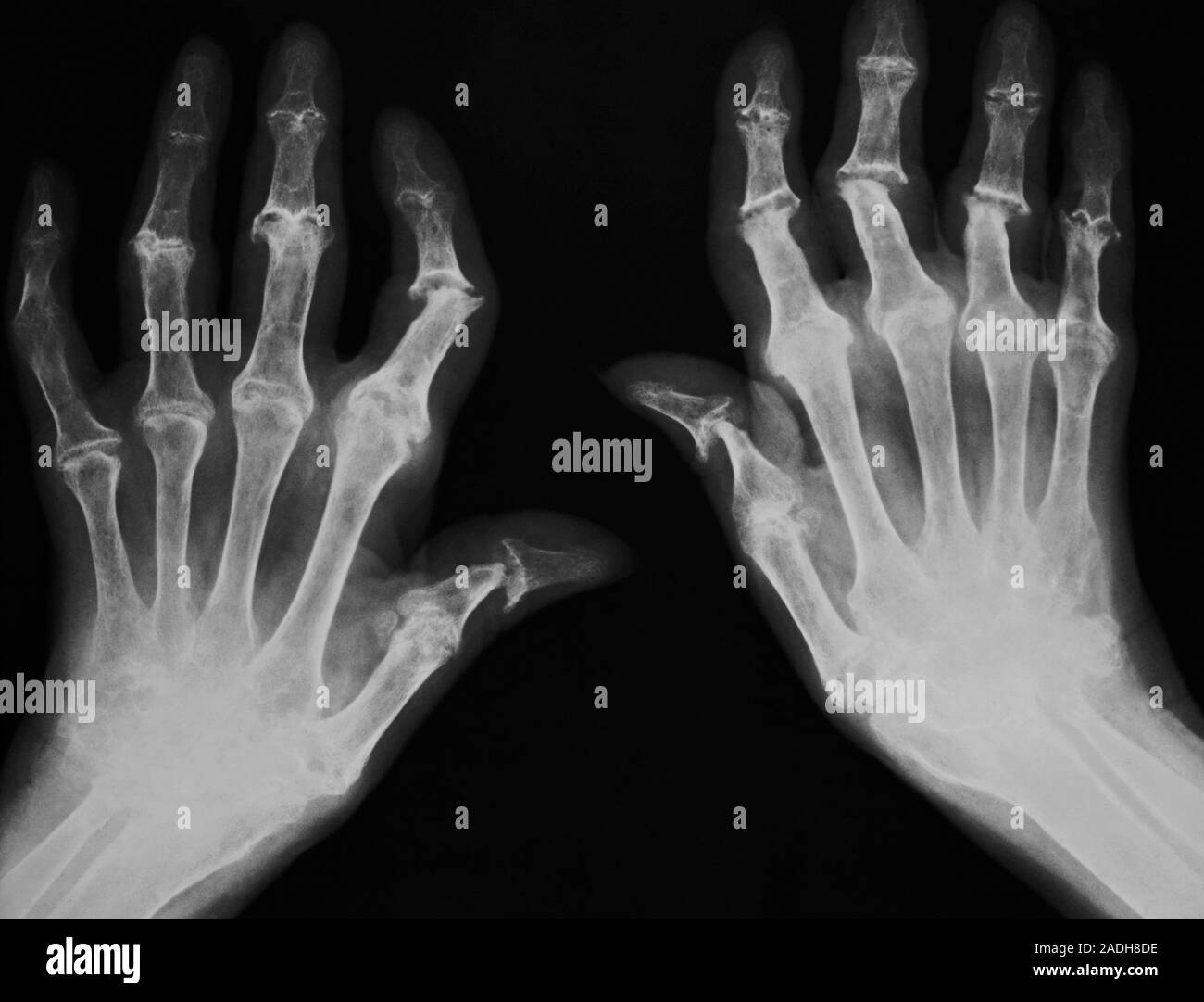 Arthritic hands. X-ray of the hands of a patient with severe rheumatoid ...