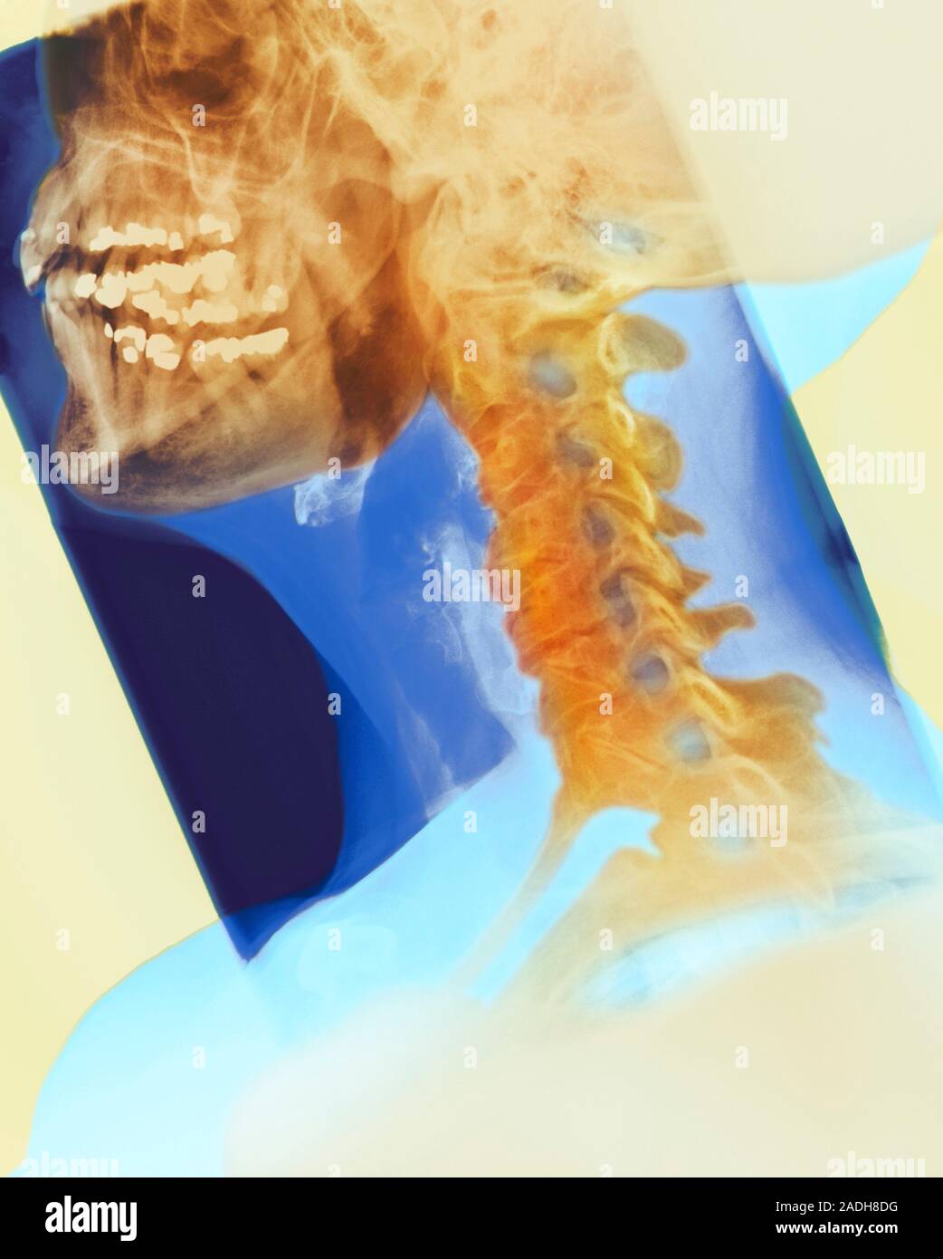 Osteoarthritis. Coloured Xray of the neck of a 74 year old woman with osteoarthritis. Healthy