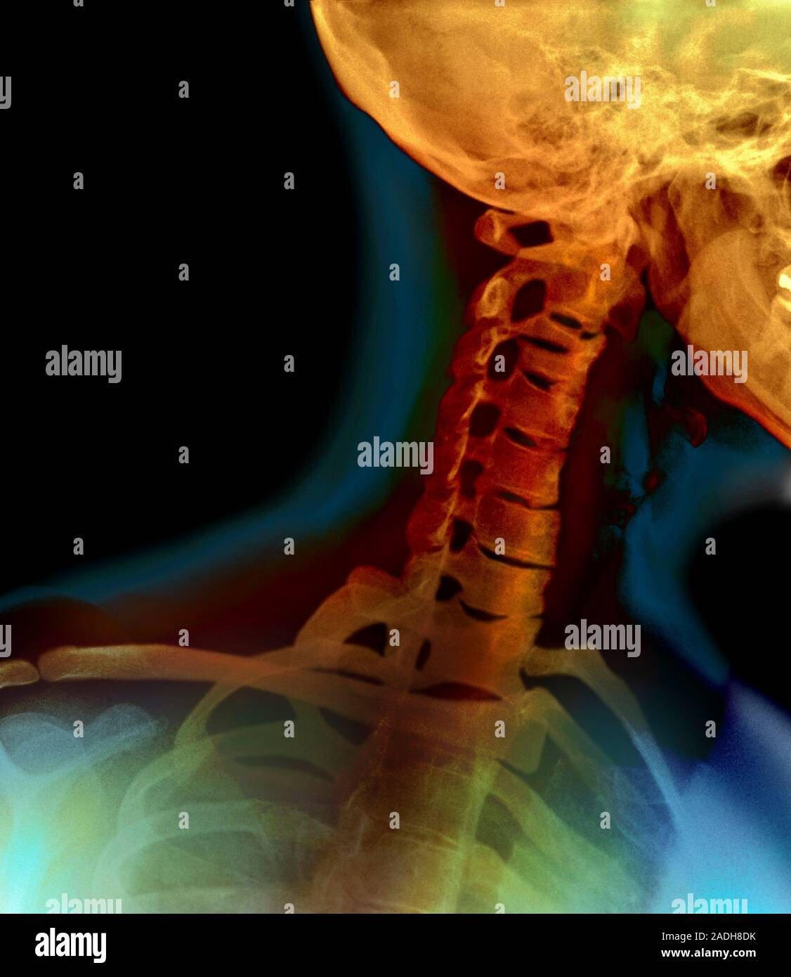 Osteoarthritis. Coloured Xray of the neck of a 45 year old woman with osteoarthritis. Healthy