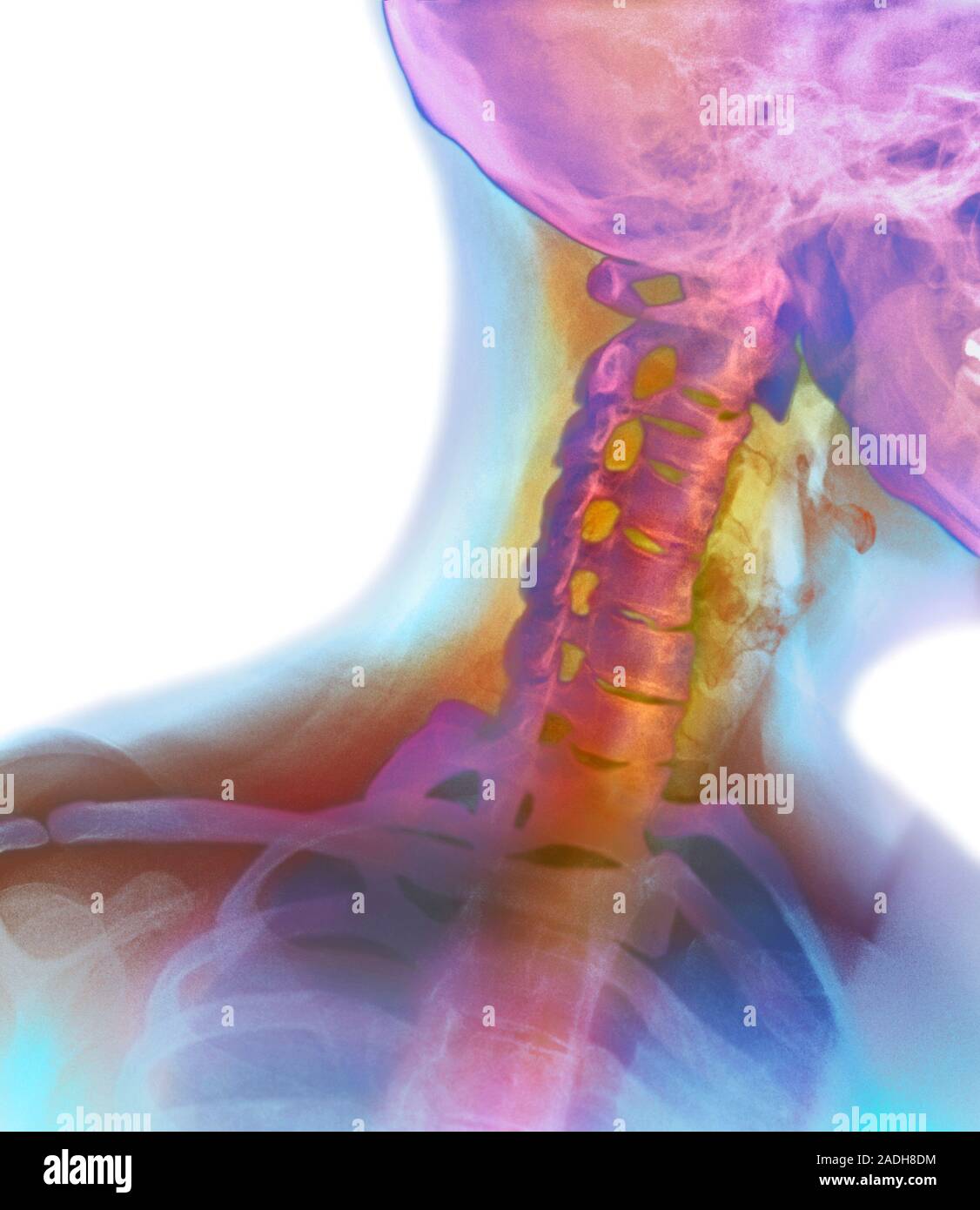 Osteoarthritis. Coloured Xray of the neck of a 45 year old woman with osteoarthritis. Healthy