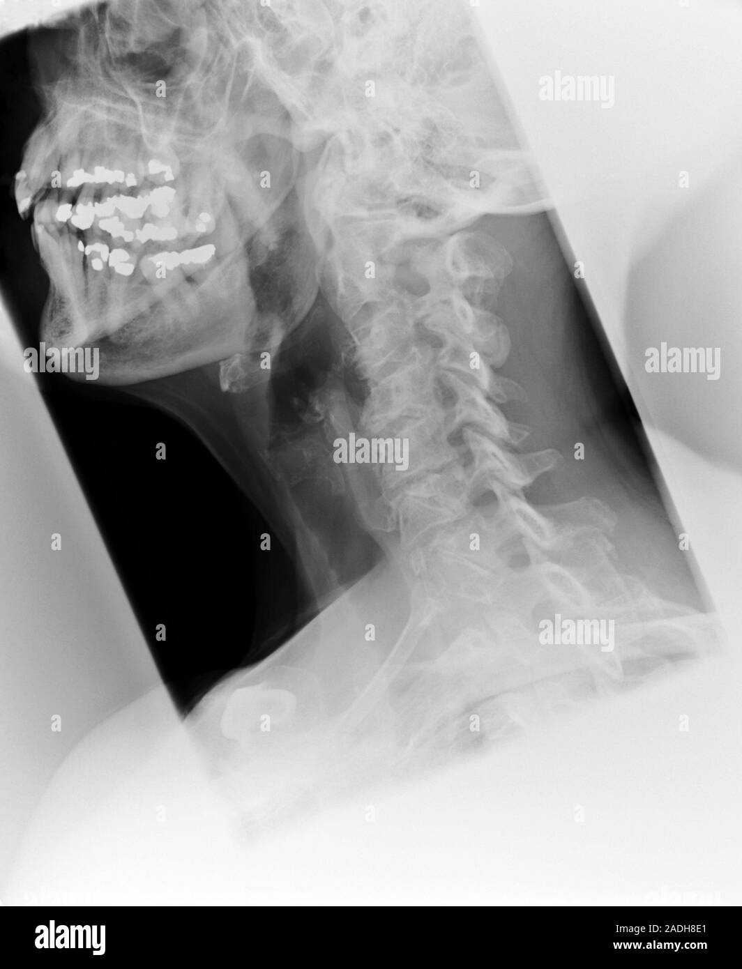 Osteoarthritis. X-ray Of The Neck Of A 74-year-old Woman With 