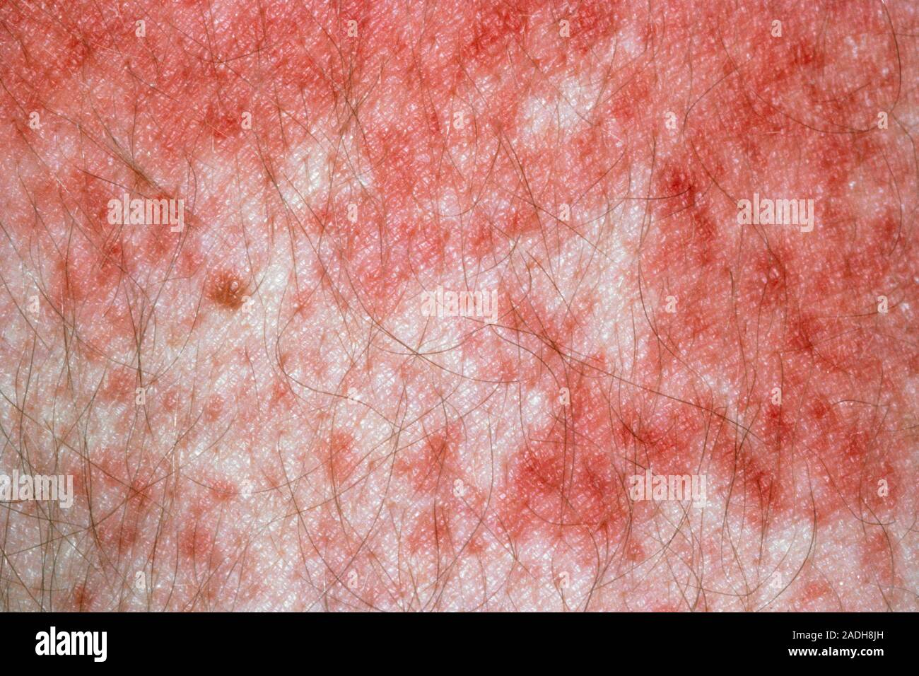 Norwegian scabies scabies rash on the hand of a person suffering from