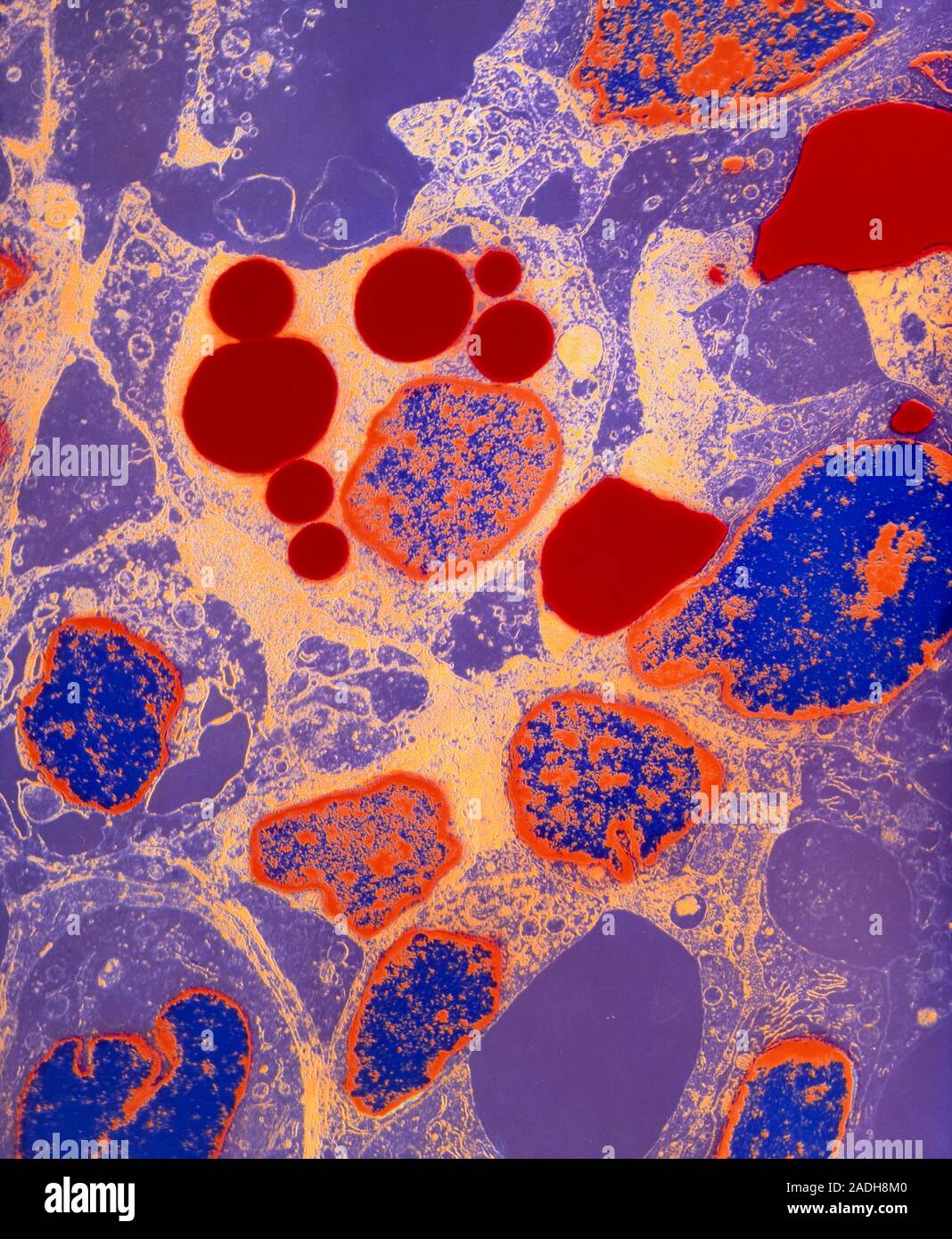 Kaposi's Coloured transmission electron micrograph (TEM) of cancer cells in Kaposi's