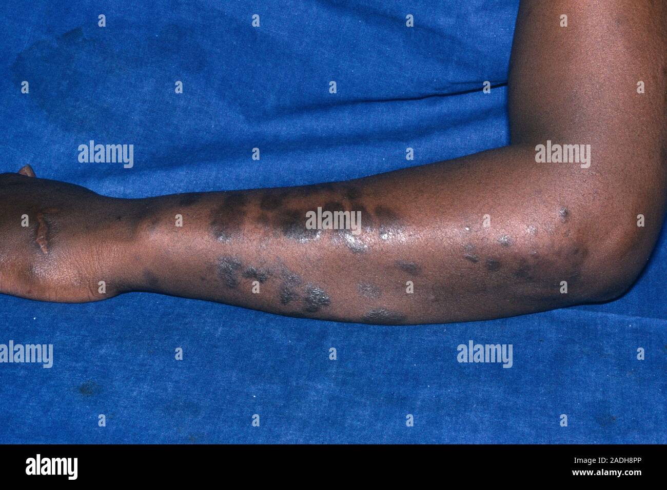 Kaposi's sarcoma. Skin plaques due to Kaposi's sarcoma, on the arm of a ...