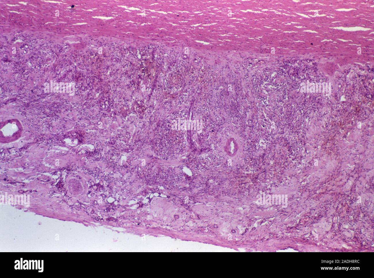 Kaposi's Light micrograph of a section through the tunica