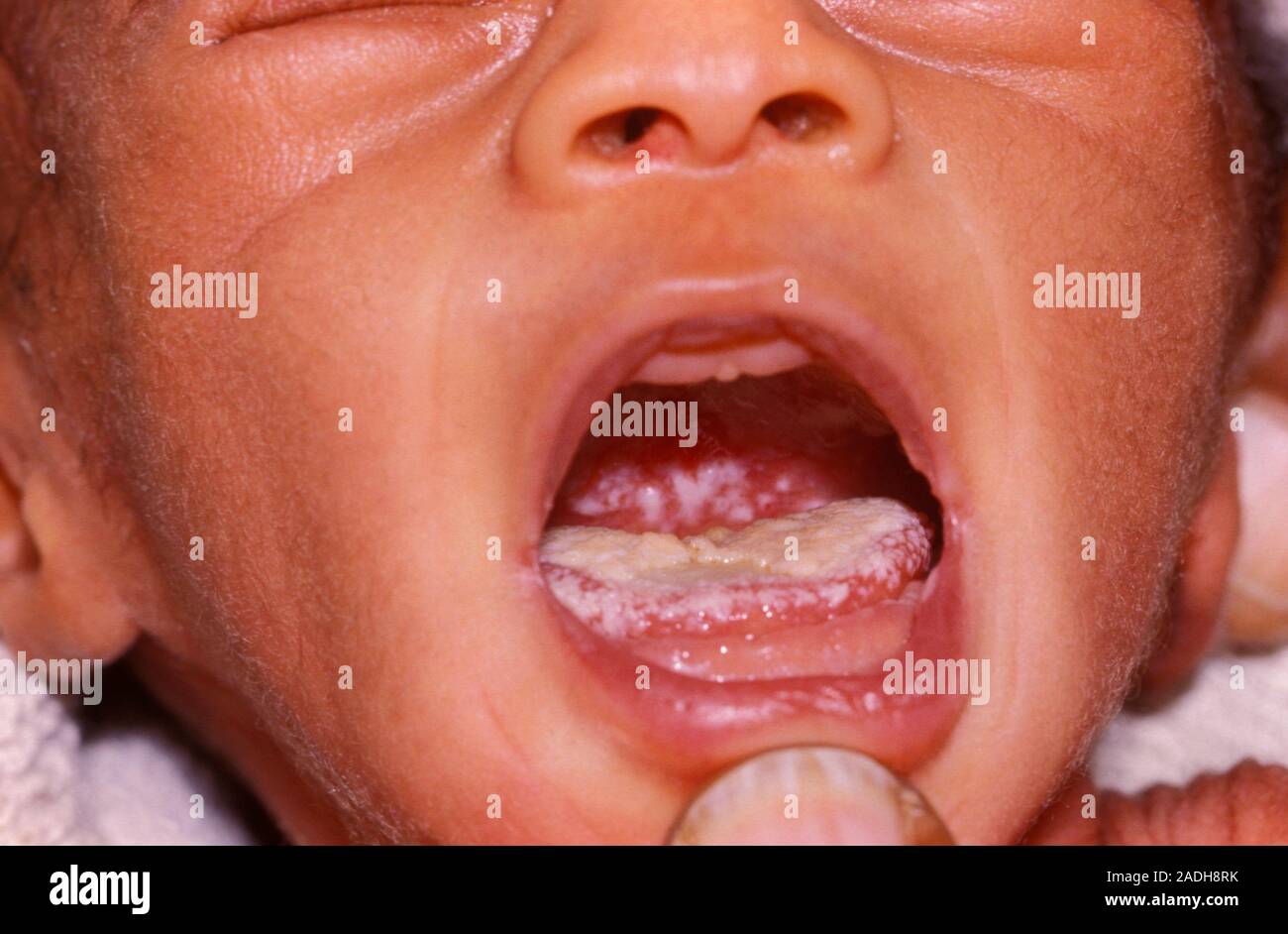 Oral thrush in an AIDS baby. The white coating on the tongue is