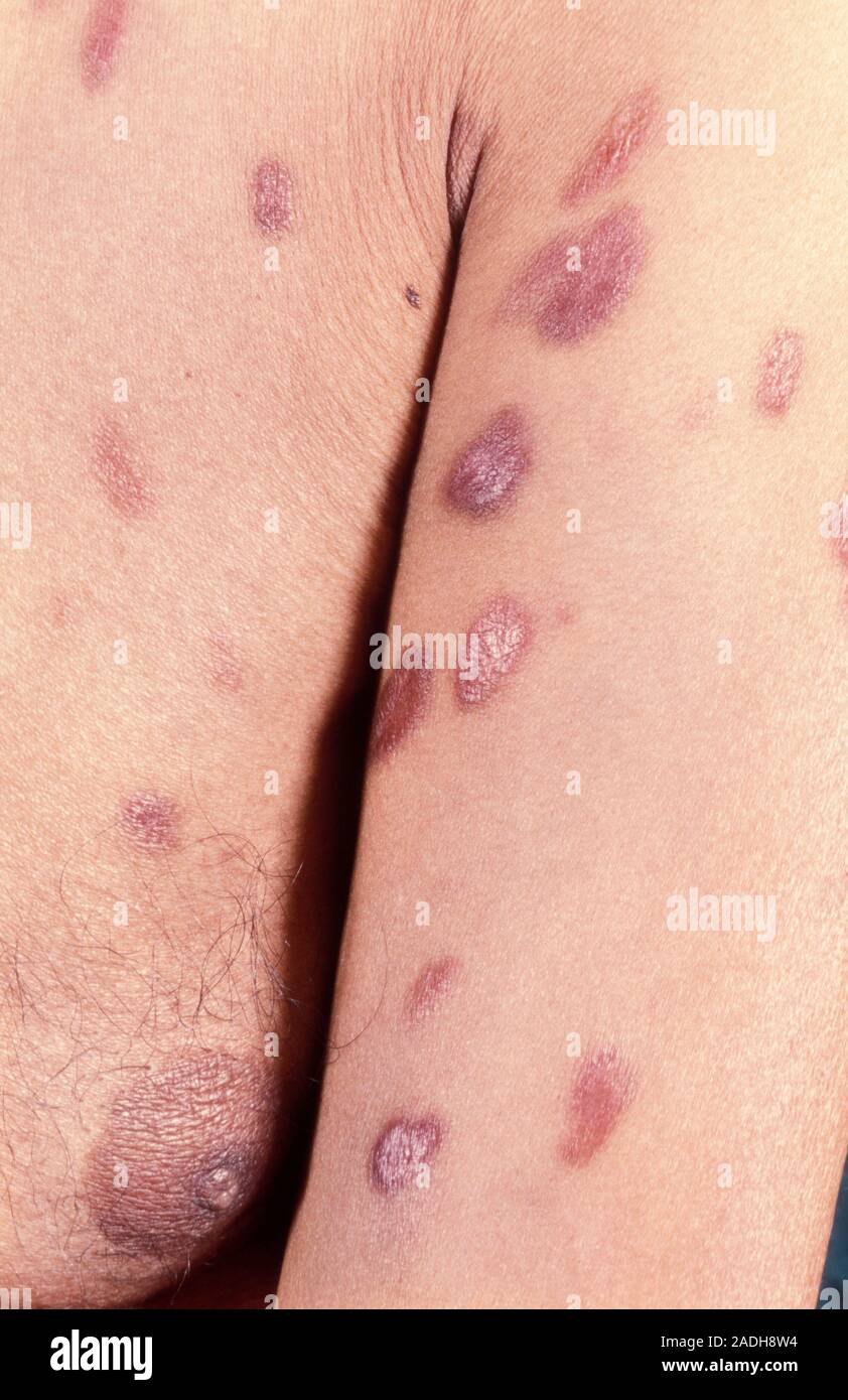 Skin plaques due to Kaposi's sarcoma on the right arm and chest of a ...