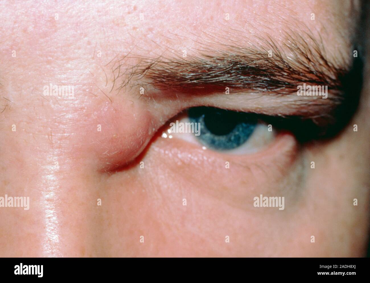 A furuncle, also known as a boil, affecting the inner canthus, the