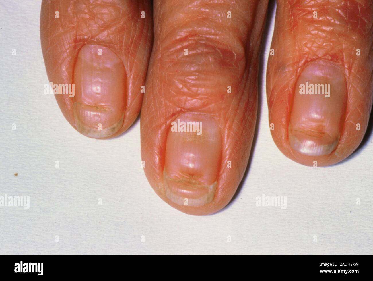 Beau's line occurring on three fingernails. This transverse groove on