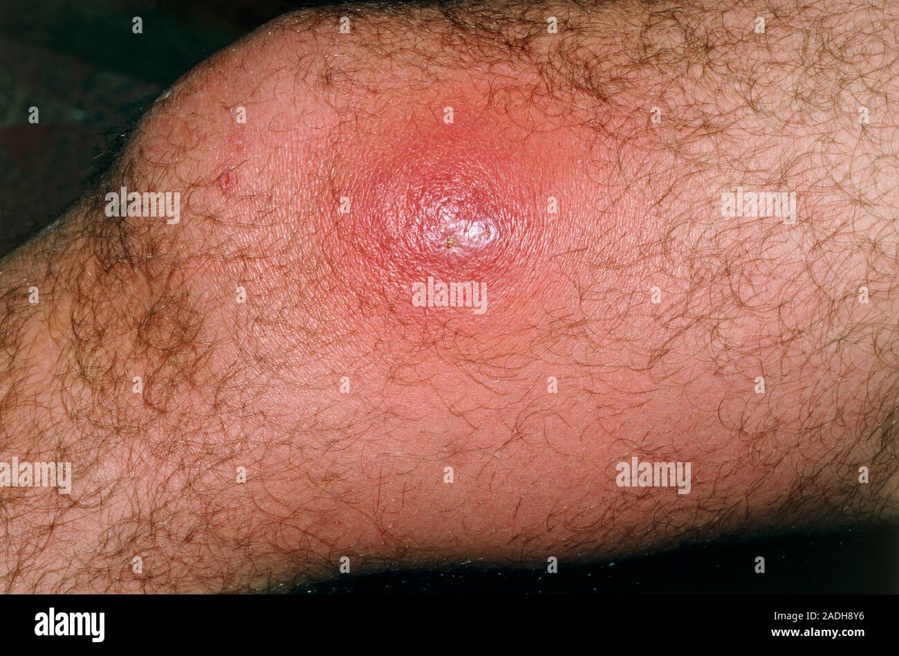 Boil on the knee. A boil (furuncle) near the knee joint of a male