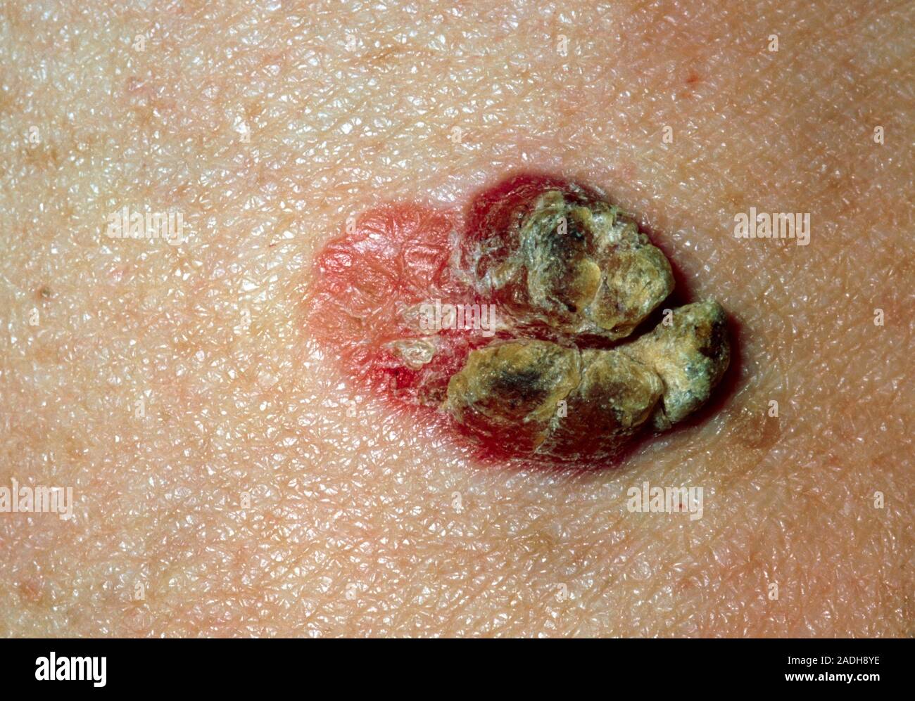 Bowen's disease. Closeup of a dark, scaly lesion on the skin of a 94