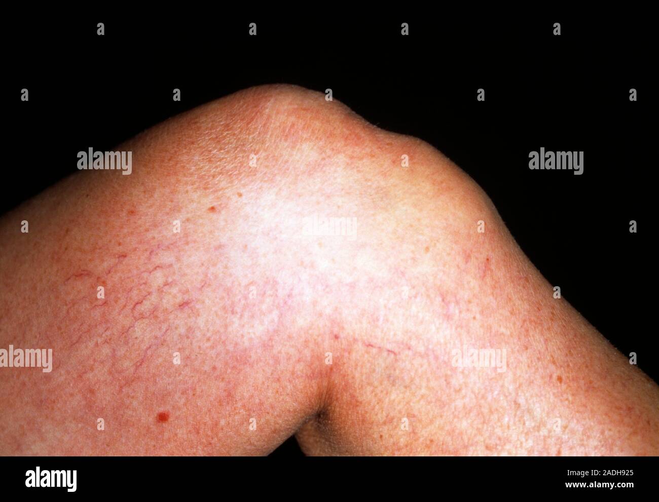 Bursitis of knee. Knee of a 57yearold woman suffering from