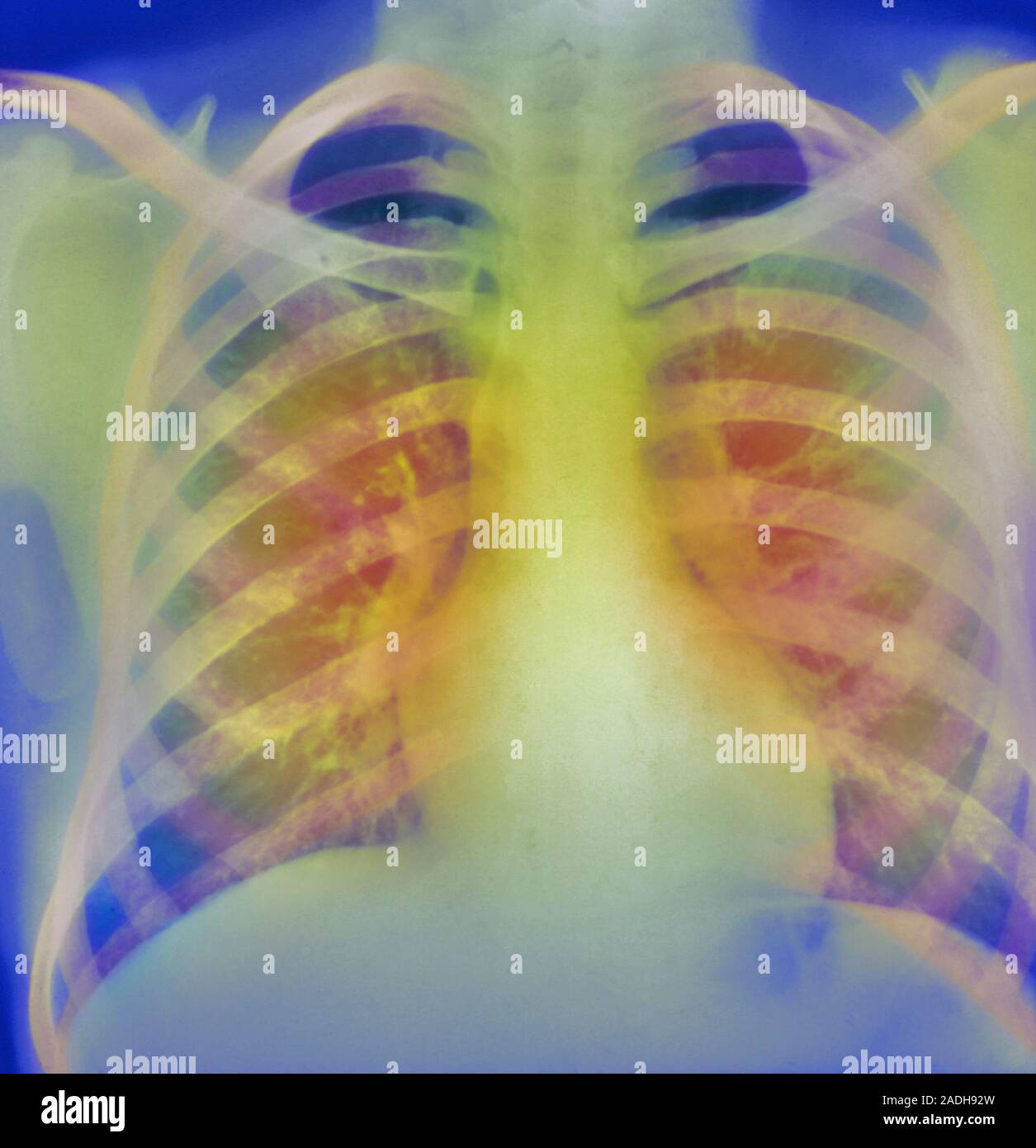Chronic bronchitis, coloured Xray. This condition almost exclusively affects smokers. It is