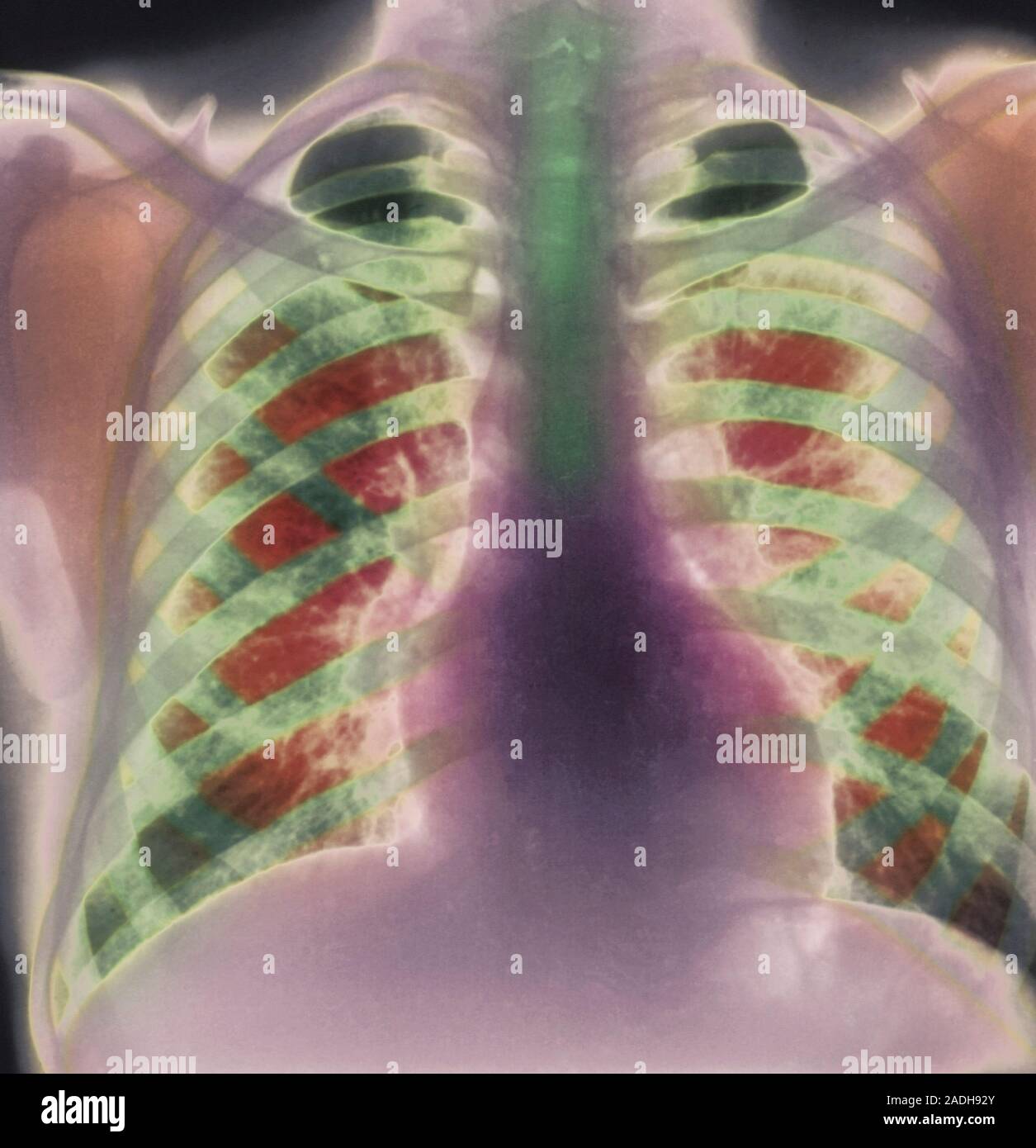 Chronic bronchitis, coloured Xray. This condition almost exclusively affects smokers. It is