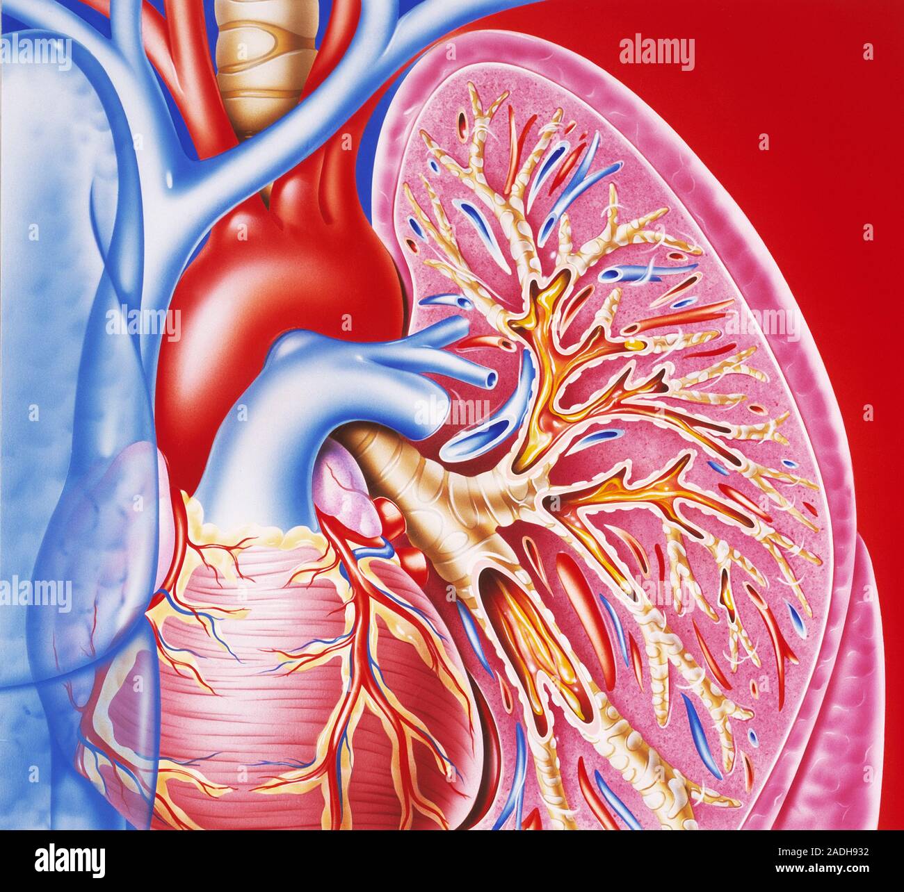 Bronchitis. Cutaway artwork of a lung showing the effects of bronchial inflammation (bronchitis