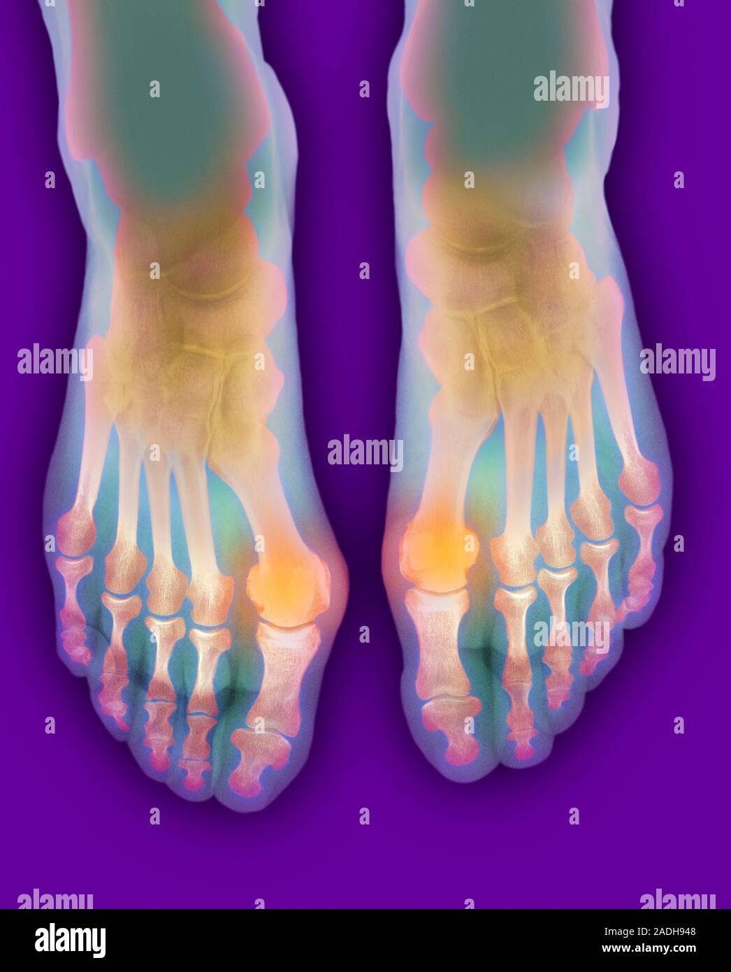 Bunions Coloured X Ray Of An Elderly Woman S Deformed Inward Turning Toes Due To Bunions