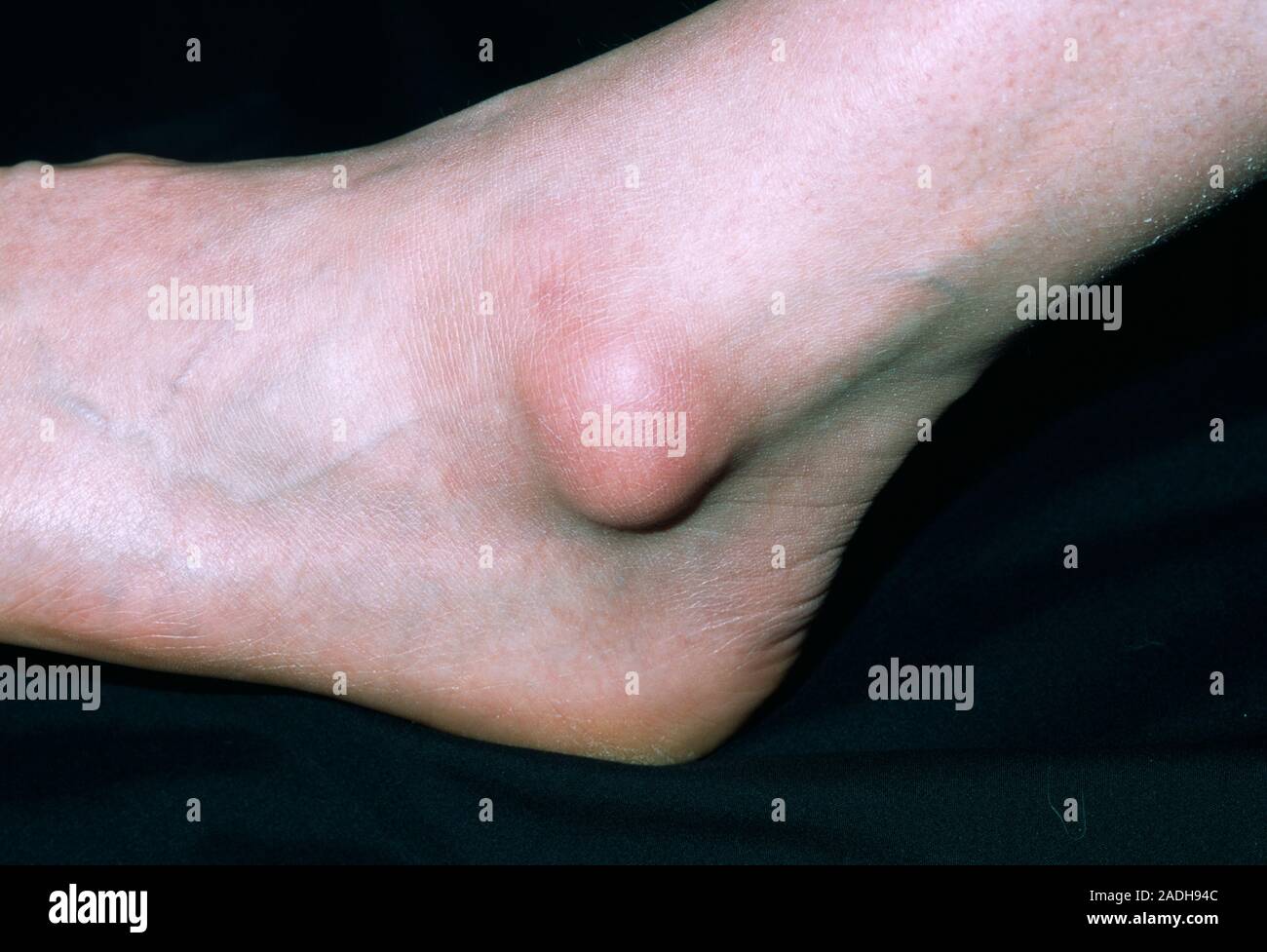 Bursa on a 41yearold woman's ankle. Bursae are fluidfilled sacs