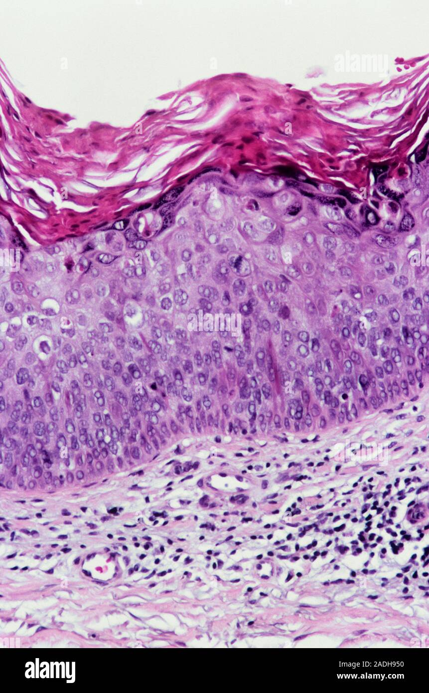 Эритроплазия кейра гистология. Болезнь кейра эритроплазия. Болезнь боуэна презентация. Микрохирургия эритроплазия кейра болезнь боуэна форум отзывы. Болезнь боуэна (morbus bowen).