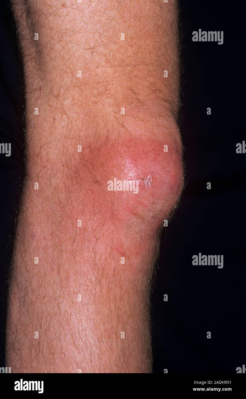 Bursitis of the knee. Swollen knee of a 40 year old man with
