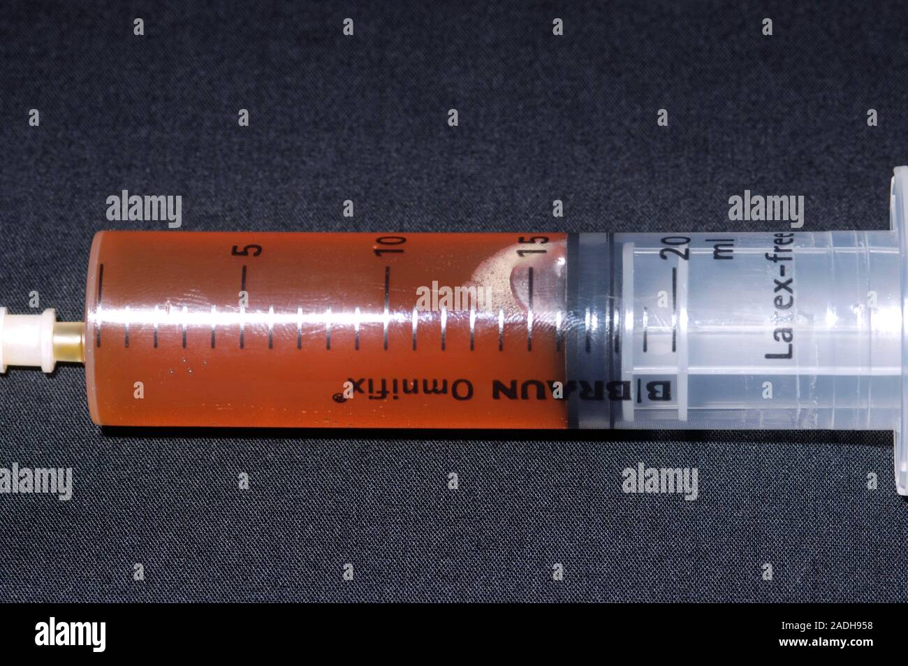 Fluid drained from a swollen elbow. Syringe filled with fluid drained