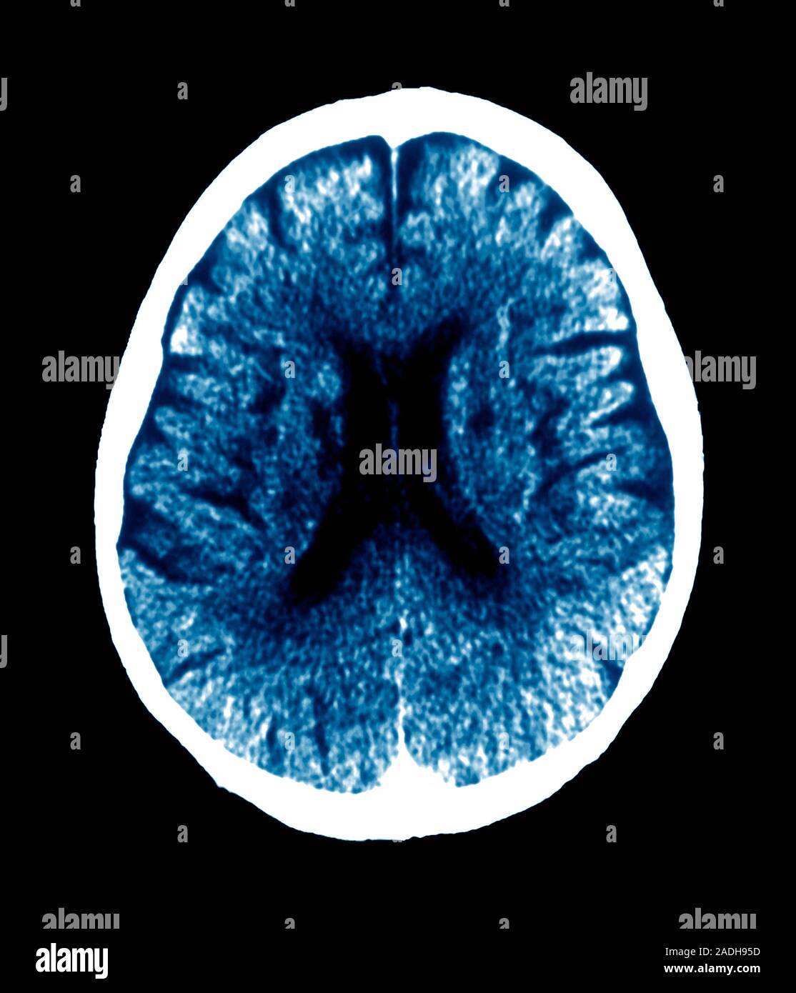 Binswanger's disease. Coloured axial computed tomography (CT) scan of