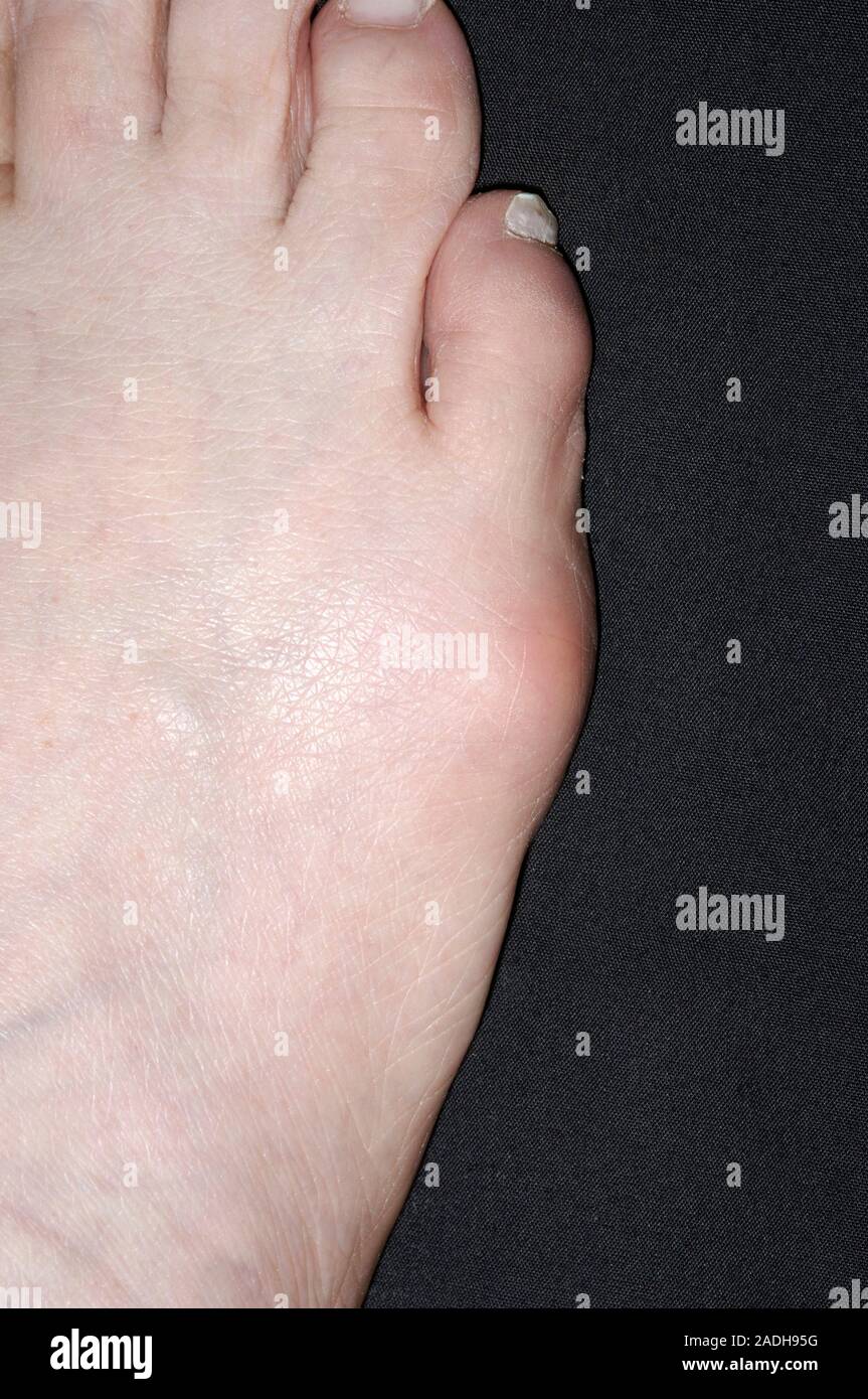 on a 53 year old woman's foot. A or tailor's bunion, is a swelling of the