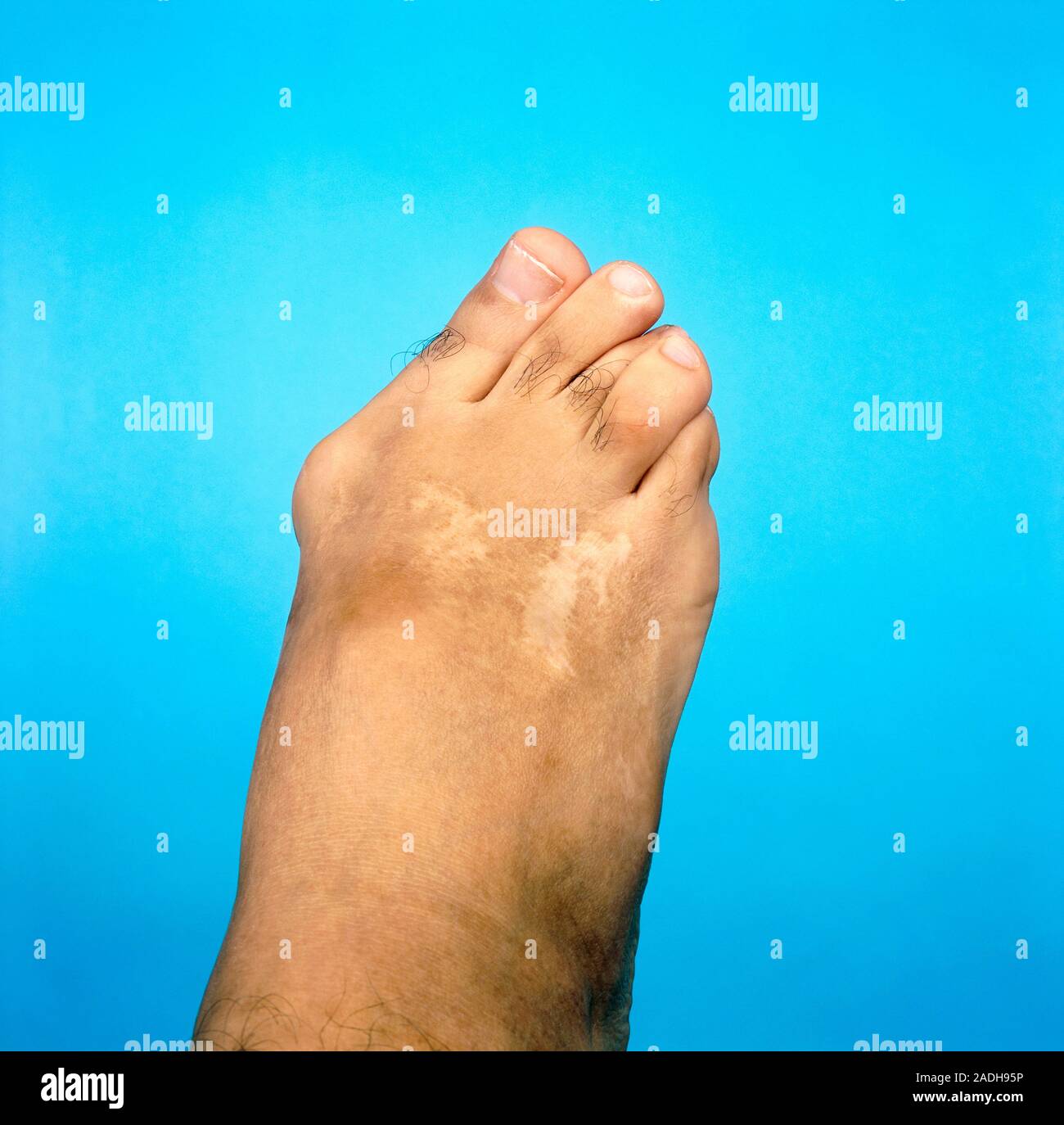 Bunion on the foot of a middleaged man. A bunion (hallux valgus) is a swollen pad overlying a