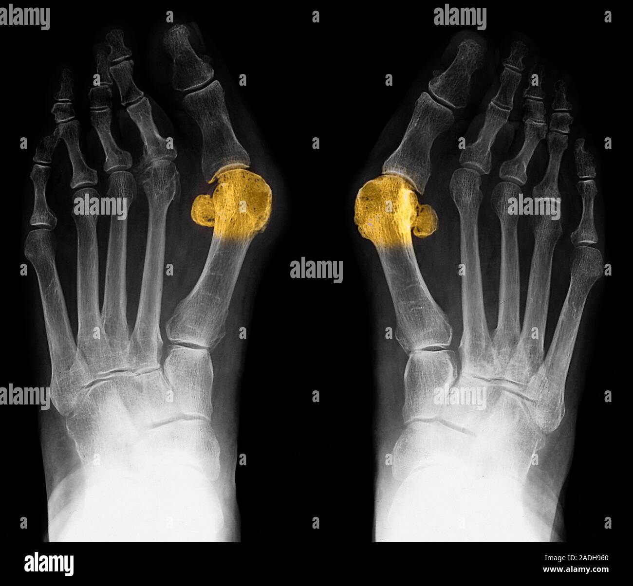 Bunions. Coloured Xray of bilateral bunions (yellow) on a 65 year old