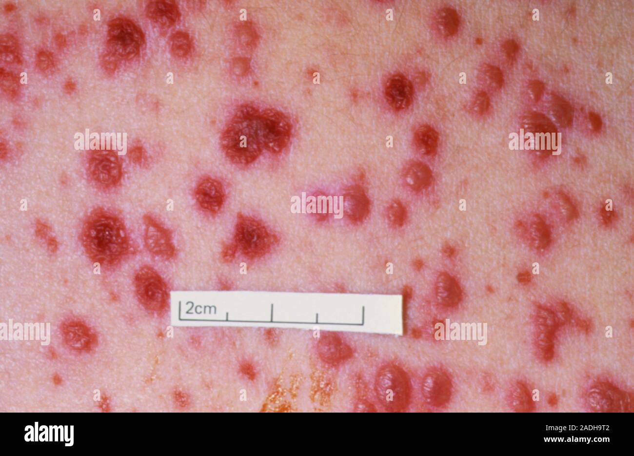 severe-chickenpox