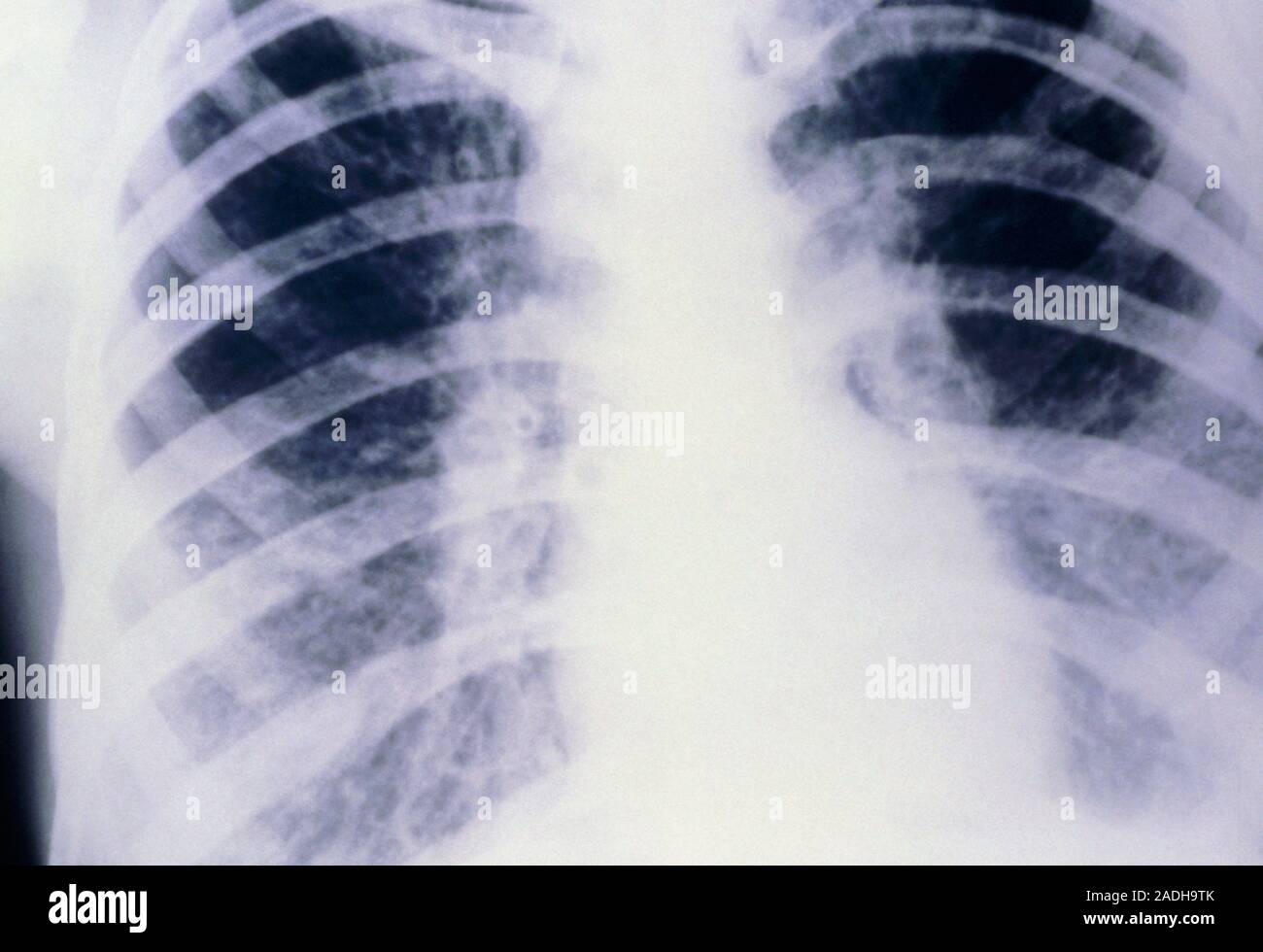 Cystic fibrosis. Xray of the chest of a person suffering from cystic