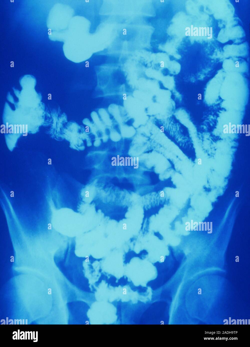 Abdominal barium Xray showing the intestine in Crohn's disease. Crohn