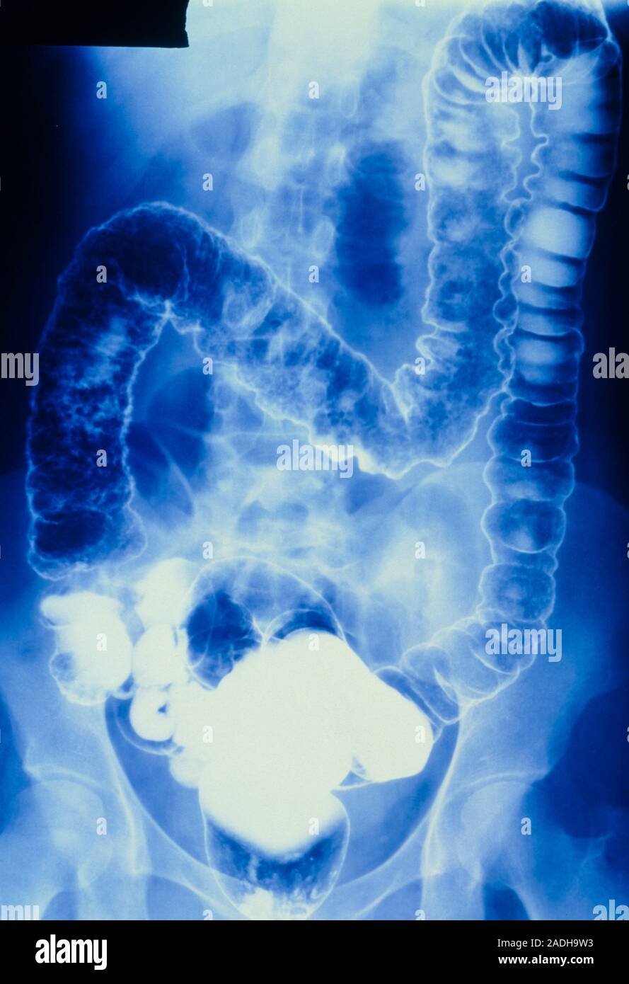 Ulcerative colitis doublecontrast barium enema Xray of the large