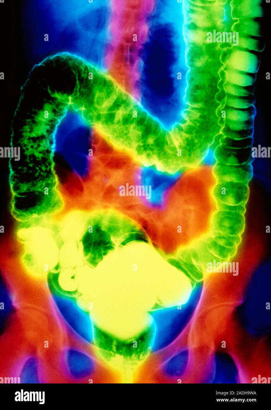 Ulcerative colitis falsecolour doublecontrast barium enema Xray of