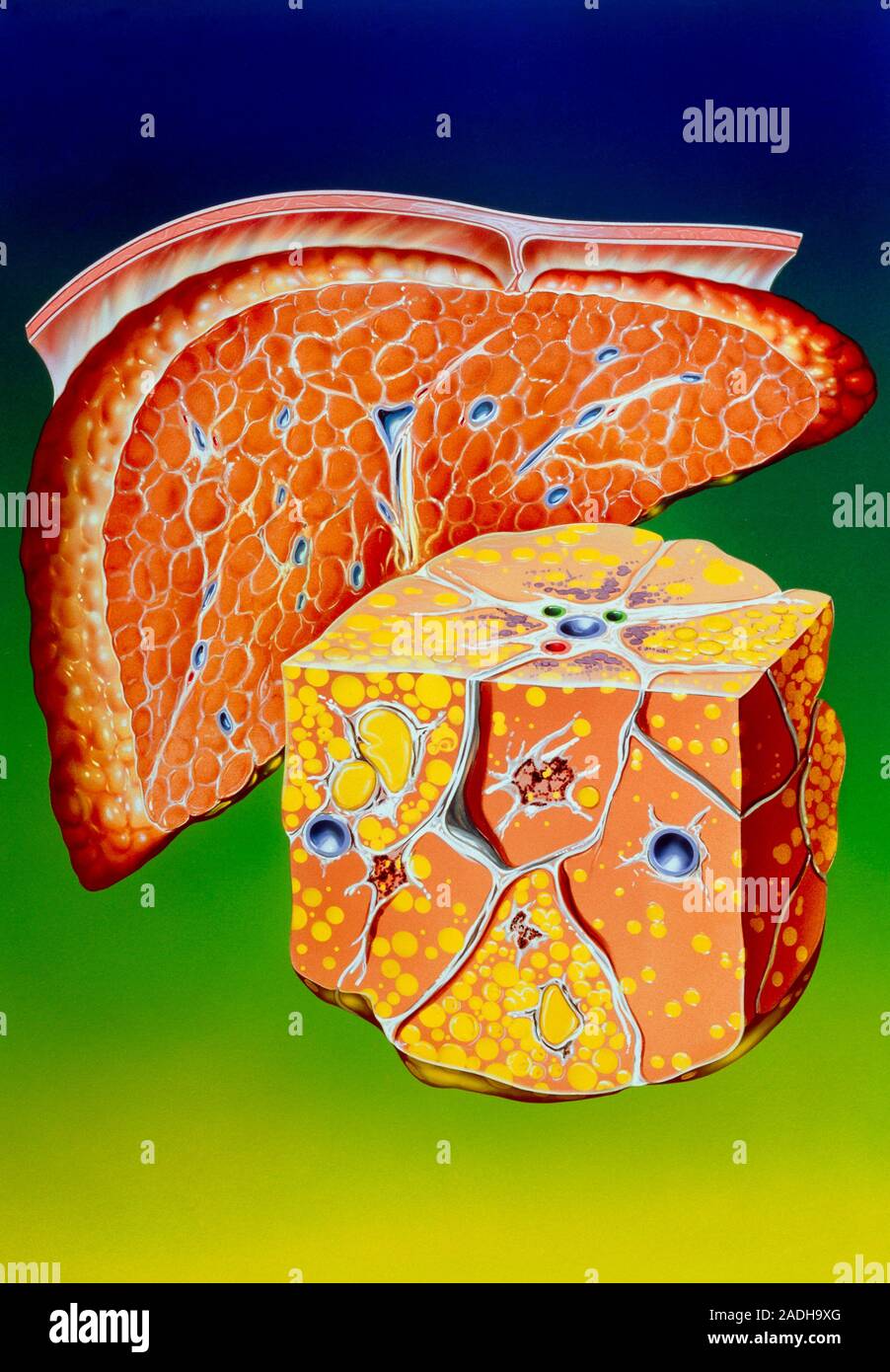 Illustration of septal cirrhosis of the liver. Cirrhosis is a liver