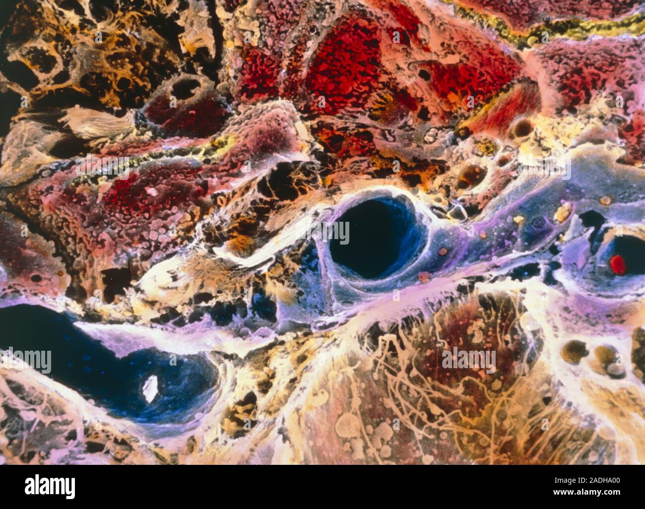 Liver cirrhosis. False-colour scanning electron micrograph (SEM) of the ...