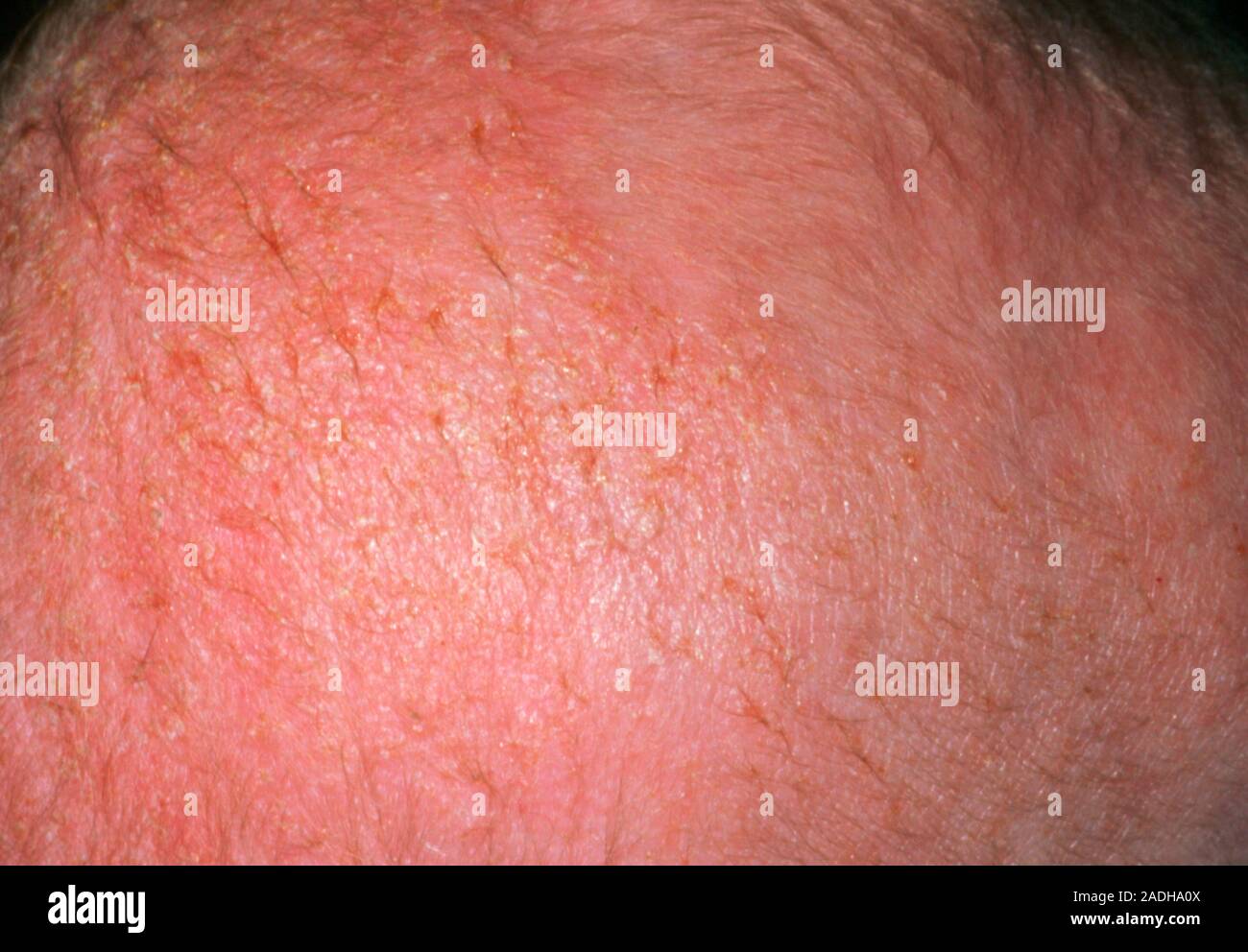 Cradle cap. Scalp of a baby suffering mild cradle cap", known also as