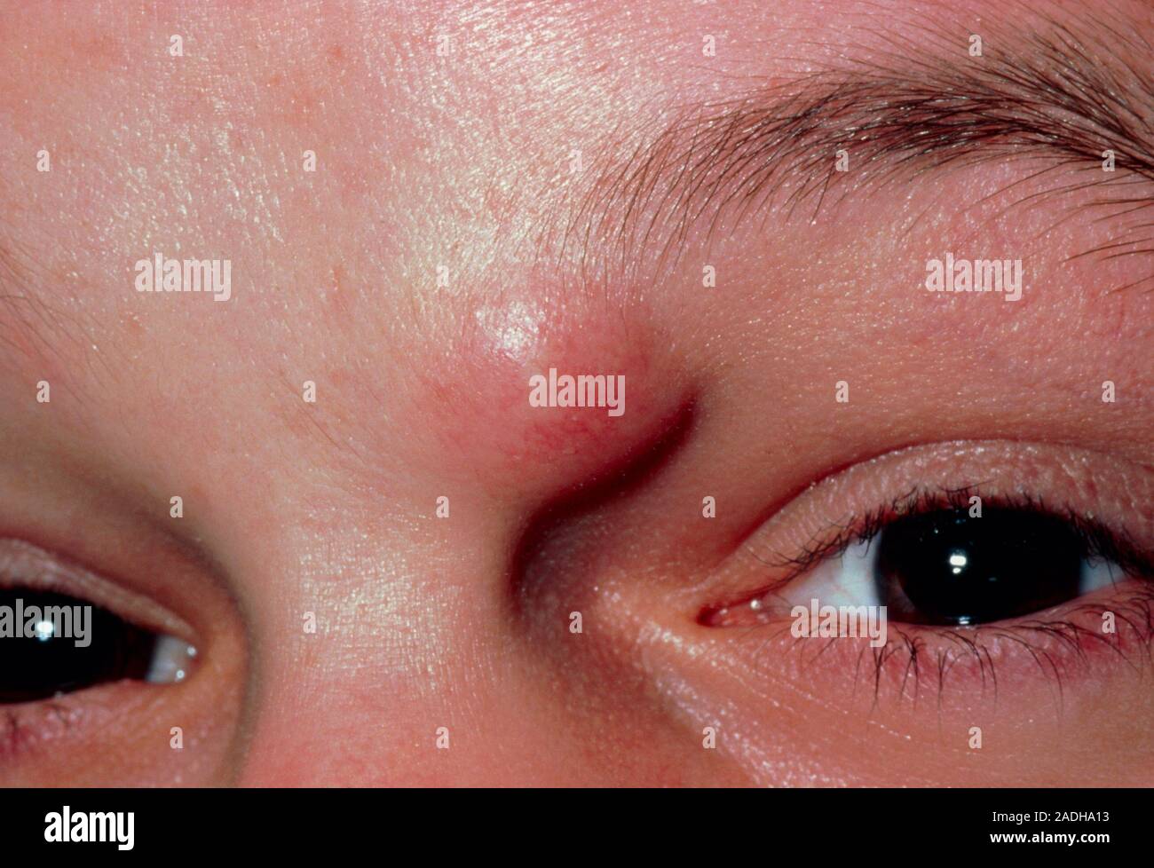 Closeup showing a sebaceous cyst near the eyebrow of a patient. The cyst contains a yellow