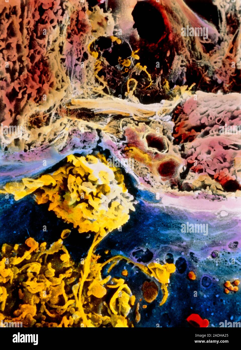Cirrhosis. Coloured scanning electron micrograph of a human liver cell ...