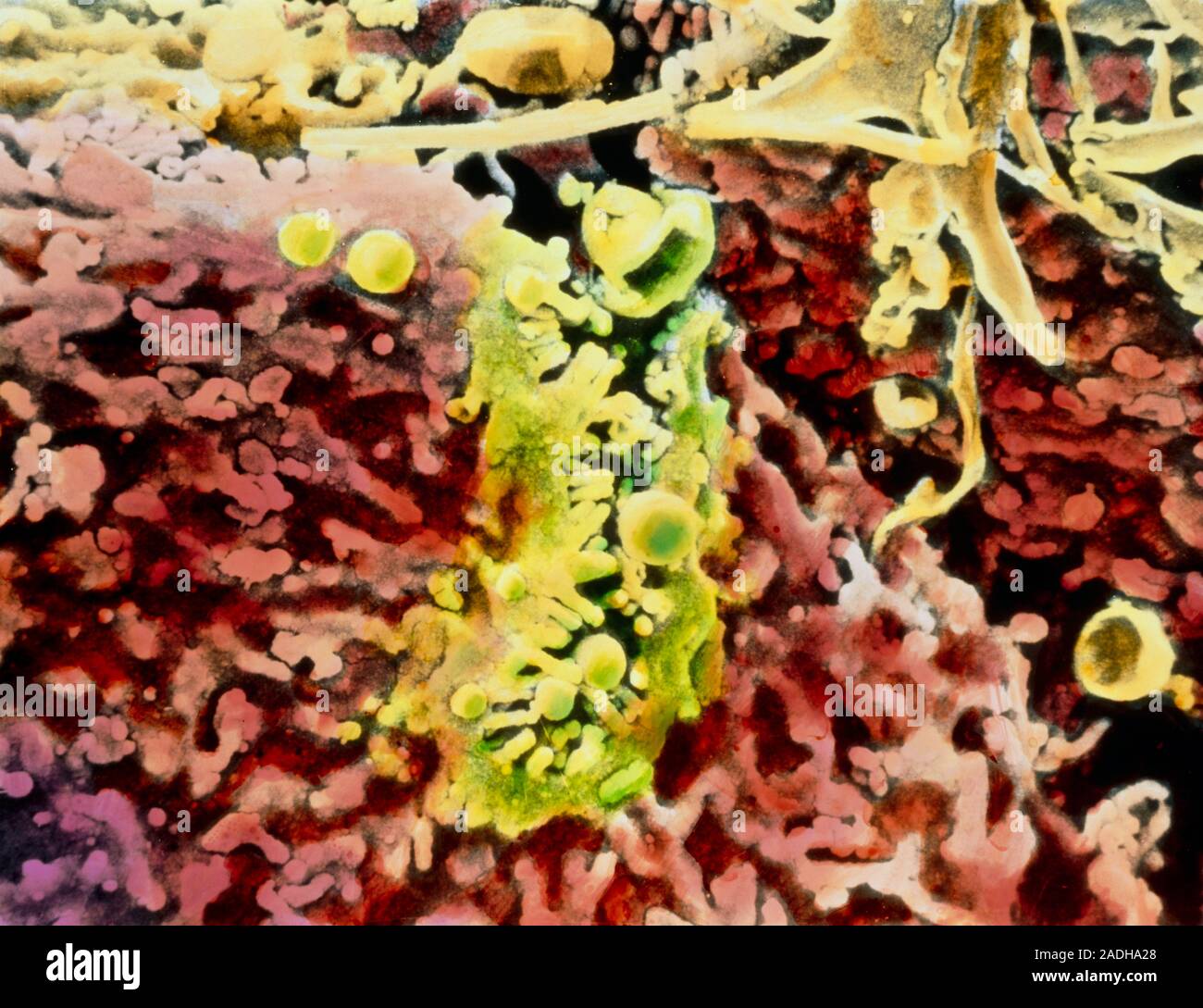 Liver disorder. Coloured scanning electron micrograph of a human liver