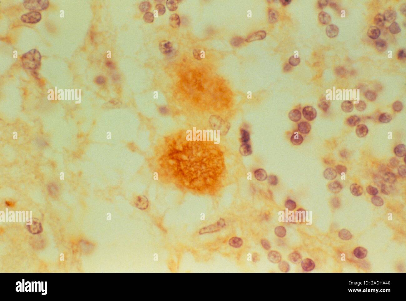 CreutzfeldtJakob disease. Immunofluorescent light micrograph of a