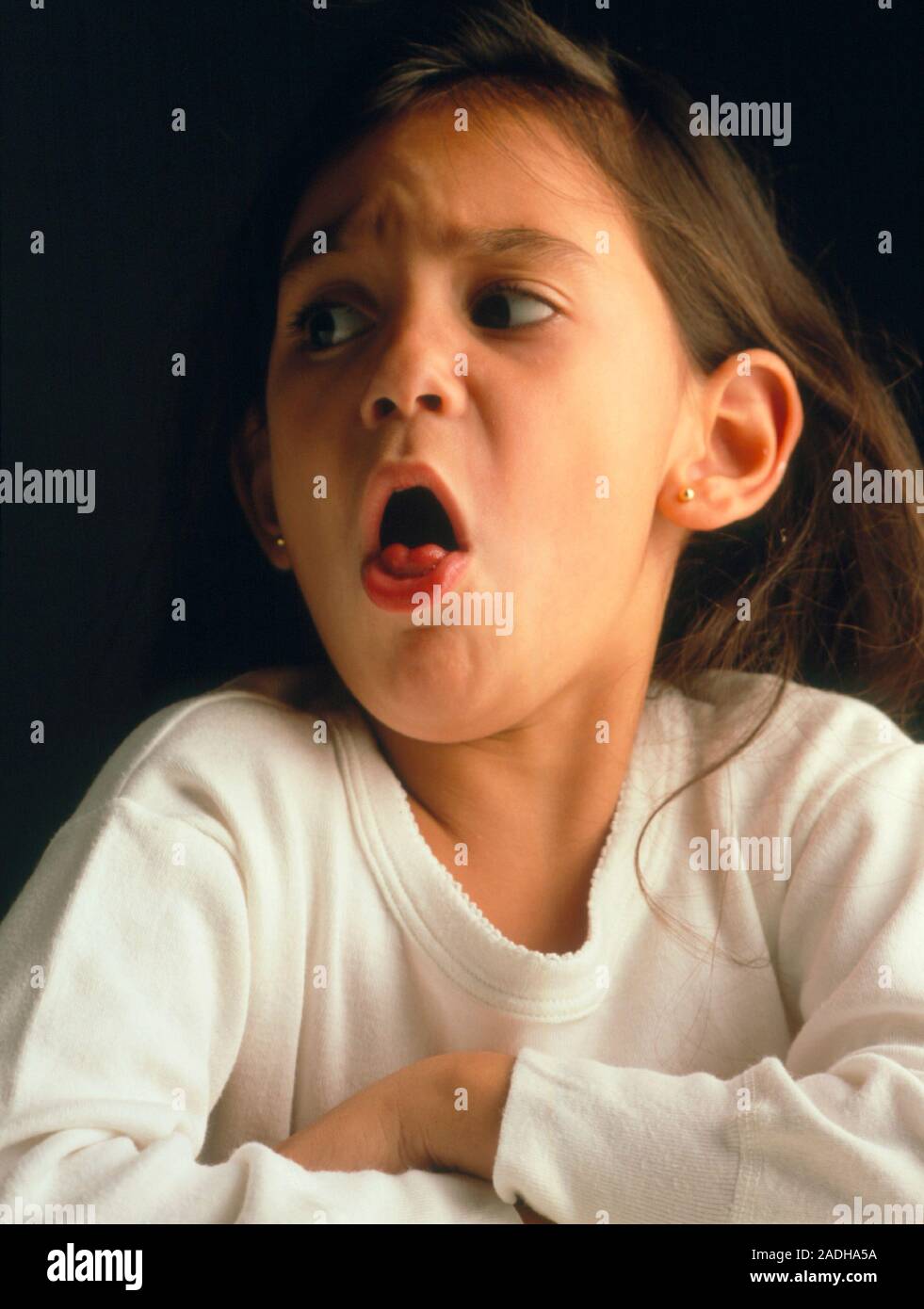 Common cold. Young girl coughing due to a cold. Inflammation of the upper respiratory tract due