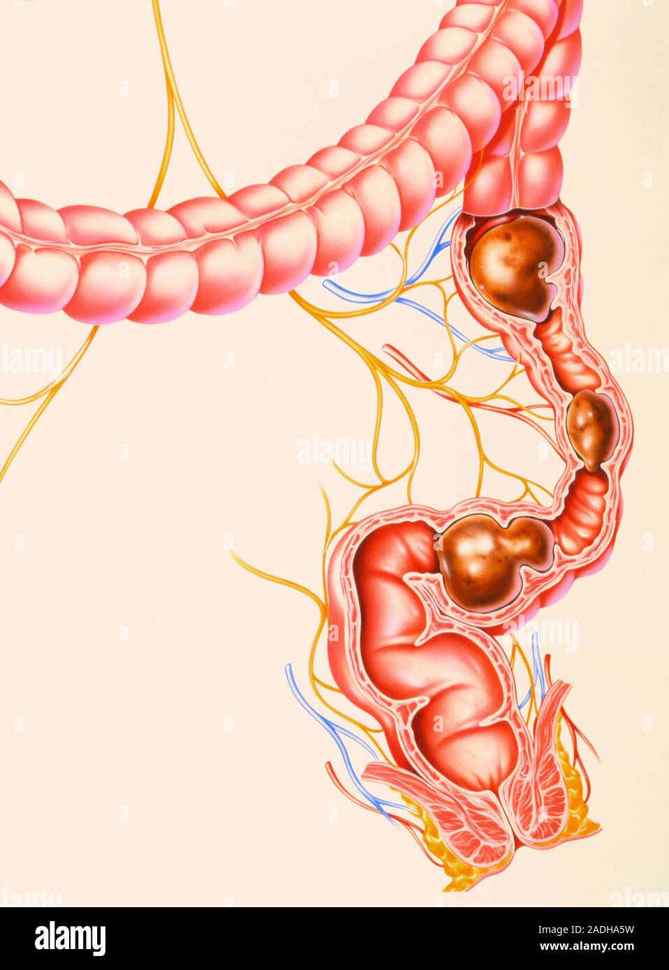 Dry Colon Constipation. Artwork showing hard, dry stools (brown) in the colon (or ...