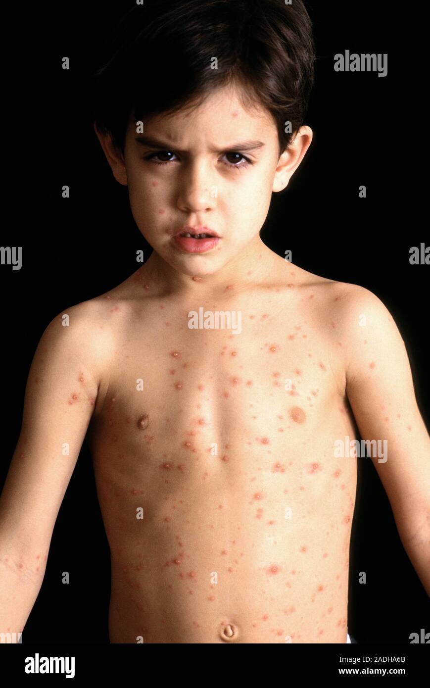 Chickenpox. Chickenpox blisters on the chest, face and arms of a 6 year