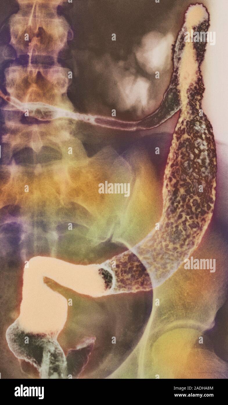 Ulcerative colitis. Coloured barium Xray of the descending colon