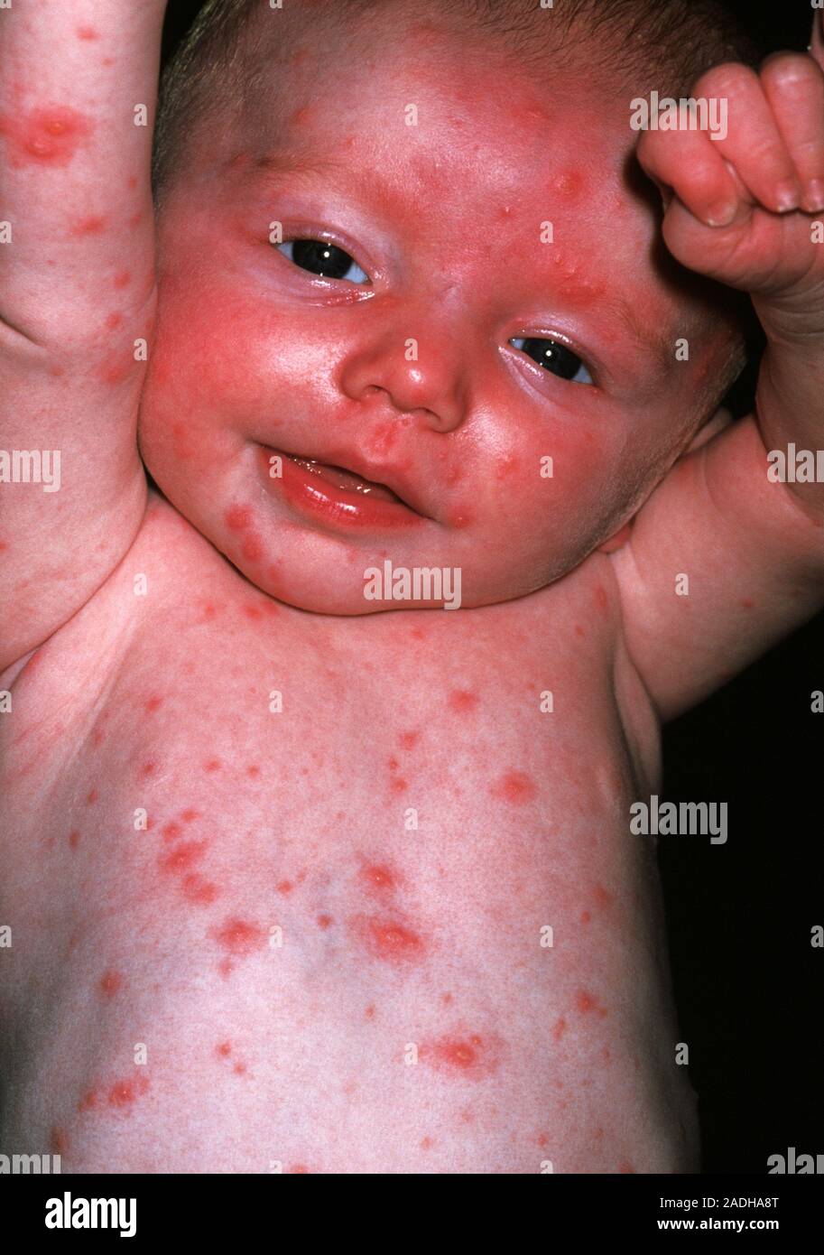 Chickenpox. 3monthold boy with chickenpox (or varicella). This is a