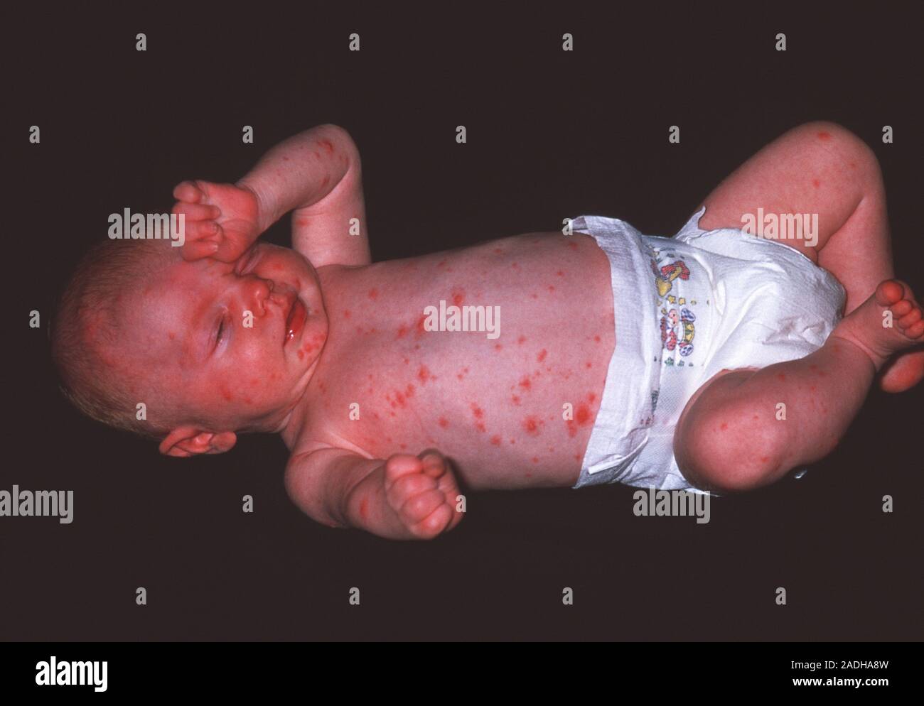 Chickenpox. 3monthold boy with chickenpox (or varicella). This is a