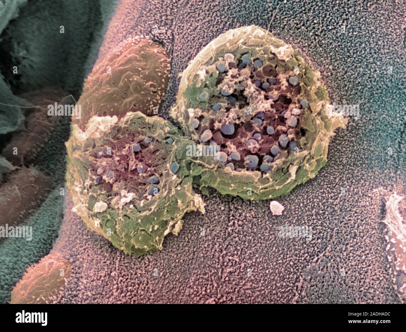 Ulcerative colitis. Coloured scanning electron micrograph (SEM) of