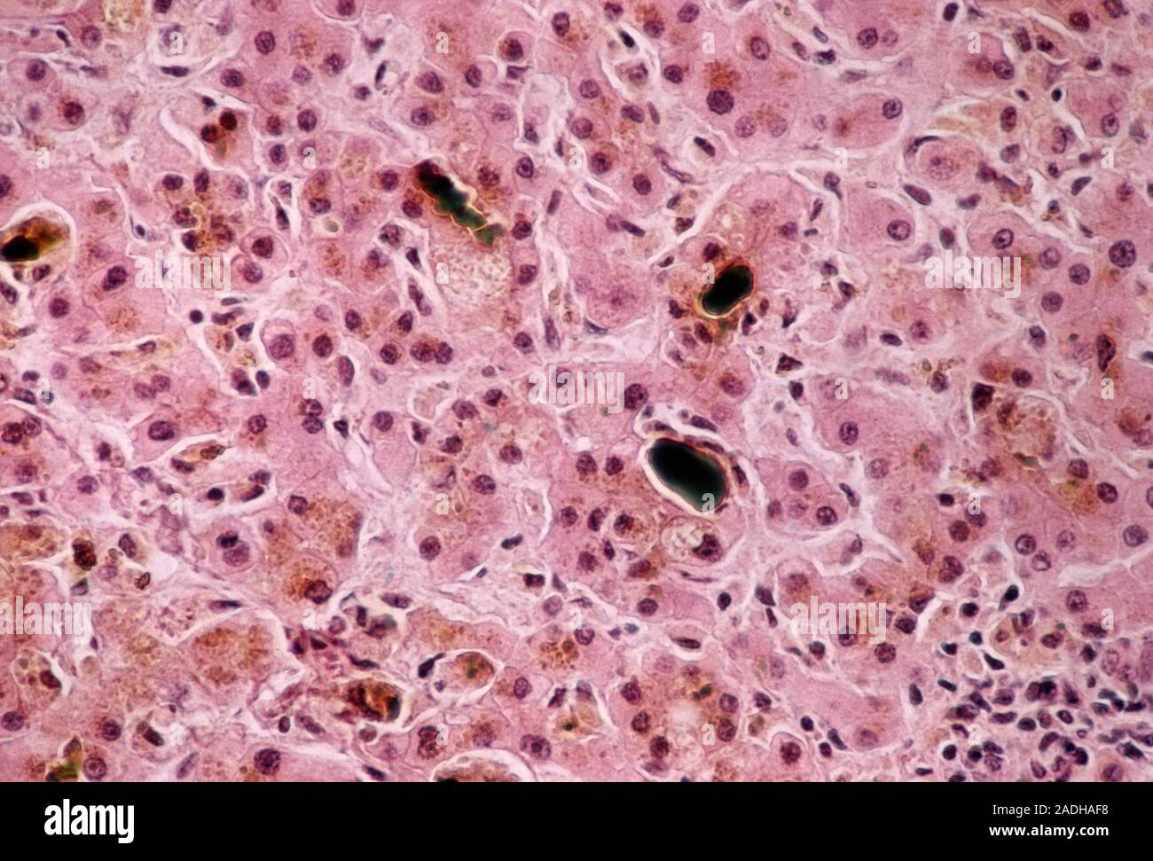 Blockage of bile ducts. Light micrograph of a section through liver