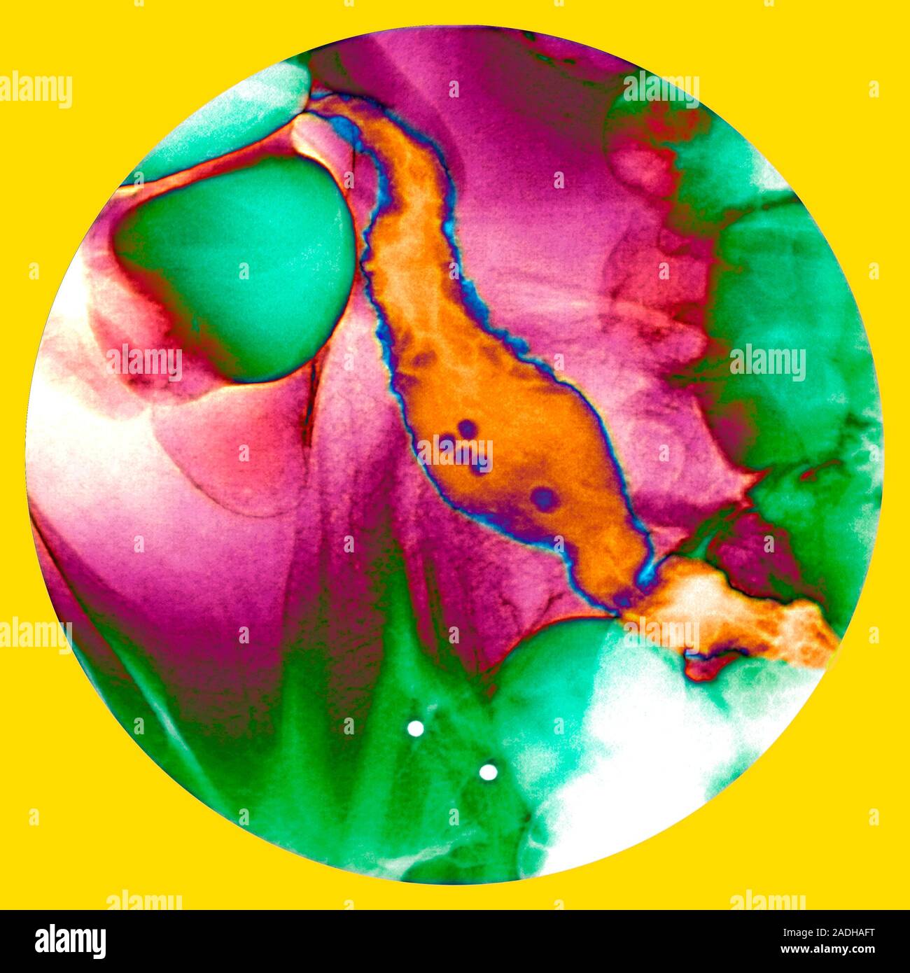 Crohn's disease. Coloured abdominal Xray showing the terminal part of