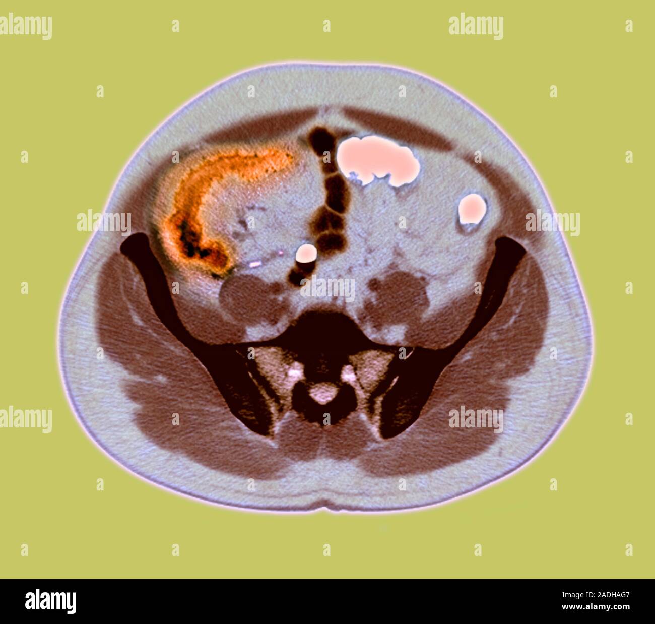 Crohn's disease. Axial coloured resonance imaging (MRI) scan